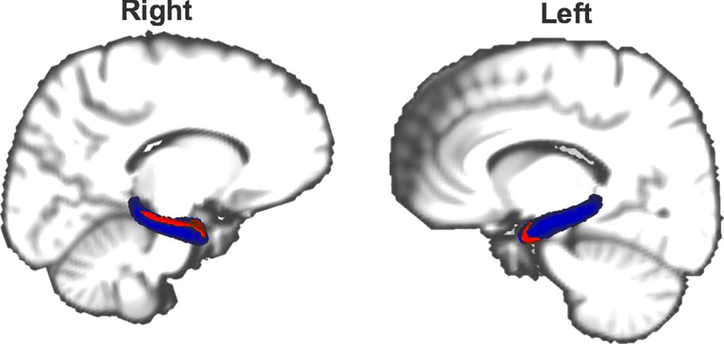 Atrophy (red) of the hippocampus (blue) in DLB compared to PD patients. Results with Family-wise error corrected p-value < 0.05 are shown. The reader is referred to the web version of this article for interpretation of the references to color in this figure legend.