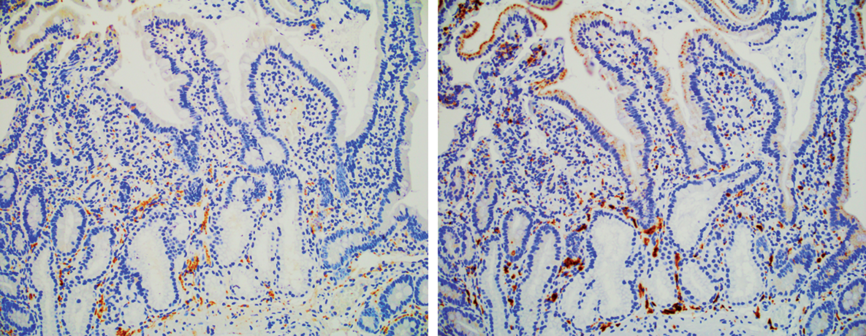 Macrophages cluster around neurons expressing αS. Human duodenal biopsy from a pediatric patient presenting with upper GI distress. Left, immune-stained for αS; Right, immune-stained for CD68 antigen (macrophage) [25].