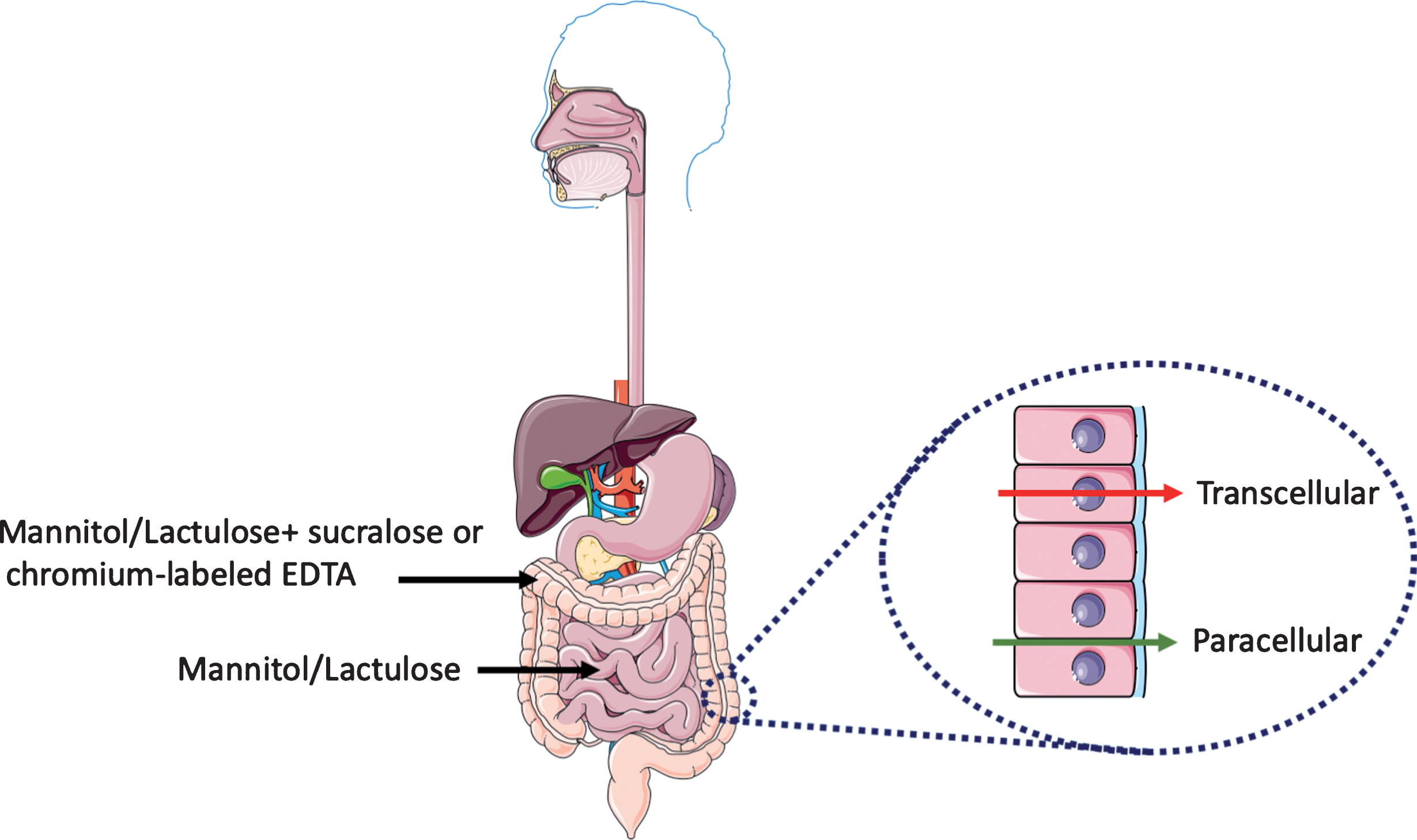 Evaluation of intestinal permeability. Urinary excretion of orally ingested non-metabolizable sugars of different sizes provides a reliable non-invasive in vivo read-out of intestinal barrier function. The mannitol/lactulose ratio evaluates the changes in permeability in the small intestine. Changes in the colon permeability is assessed with the addition of either sucralose or chromium-labeled EDTA. At the cellular level, there are two routes for transport of molecules and ions across the epithelium of the gut: across the plasma membrane of the epithelial cells (transcellular route) and across tight junctions between epithelial cells (paracellular route). This figure was created using Servier Medical Art, licensed under the Creative Commons Attribution 3.0 Unported License.