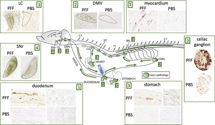 Injection of asyn preformed fibrils (PFF) into the duodenum of transgenic rats leads to robust propagation of phosphorylated, aggregated asyn through the sympathetic nervous system via the celiac ganglion (CMG) to the IML, and via the vagus nerve to the DMV. Caudo-rostral propagation was seen in the brainstem with involvement of the LC and substantia nigra pars reticulata (SNr). Striking asyn pathology was seen in the sympathetic nerves of the myocardium indicative of anterograde propagation from the cervical ganglia (CG) of the sympathetic trunk (ST). Pathology was also seen in the ENS of the stomach several centimeters from the injection site indicative of anterograde propagation from the DMV or celiac ganglion. No pathological asyn was seen in control transgenic animals injected with phosphate-buffered saline (PBS) in the duodenum.