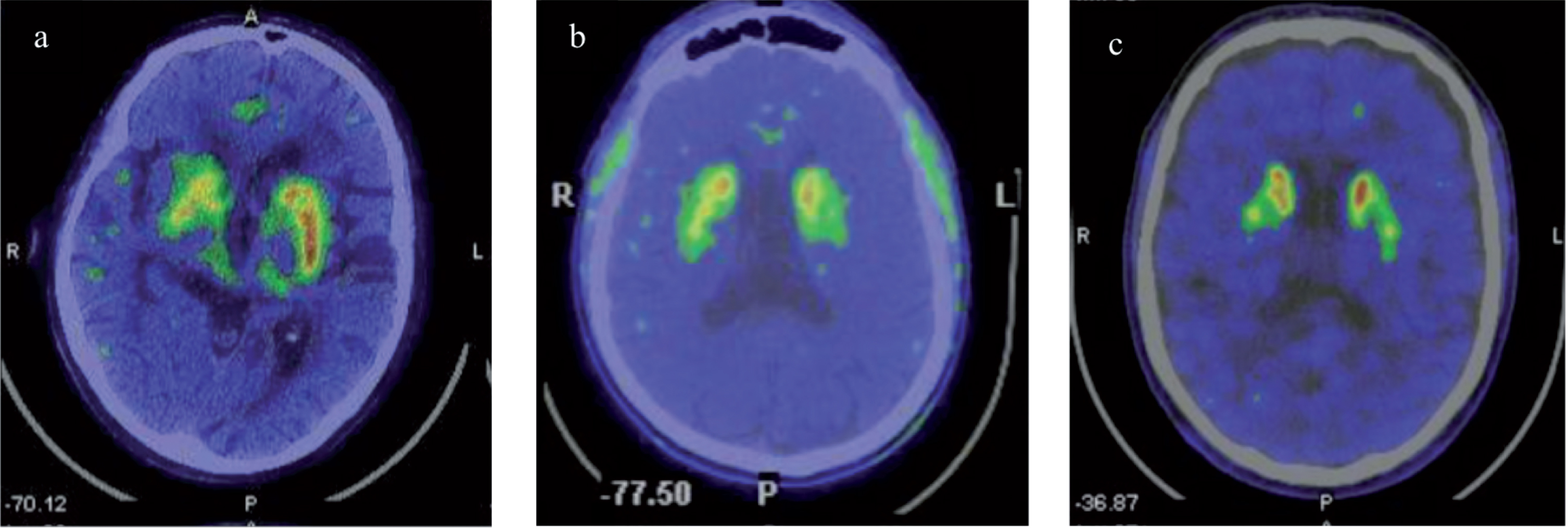 18F-DOPA PET scan performed in patients with Fabry Disease and Parkinson’s Disease revealed: a) reduced right striatal dopaminergic presynaptic deficit in patient P1; b) reduced left striatum dopaminergic presynaptic deficit in patient P2; c) and reduced right nigro-striatal dopaminergic presynaptic deficit in patient P3.