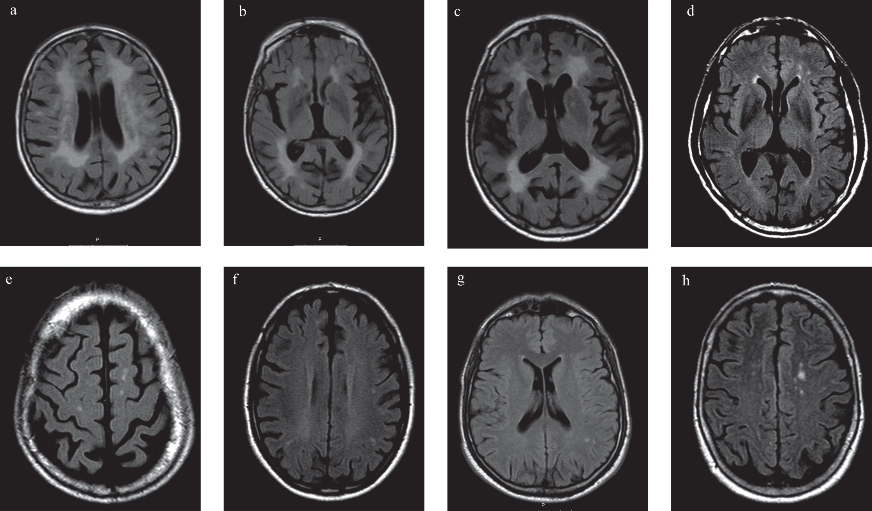 Brain magnetic resonance imaging (MRI) with axial Fluid Attenuated Inversion Recovery (FLAIR) of patients with Fabry disease (FD) and Parkinson’s disease (PD) (P1, P2, P3) and FD without PD (FD+PD–). a, b, c) MRI of P1; a) and b) Diffuse confluent bilateral hyperintensities in the periventricular and subcortical fronto-parietal white matter, suggesting leukoencephalopathy; c) Basal ganglia lacunar infarcts; d, e) MRI of P2, Frontal periventricular and subcortical white matter hyperintensities; f) MRI of P3, Frontoparietal periventricular and subcortical white matter hyperintensities; g) MRI of 43 years old, male with FD+PD–, White matter hyperintensities in the left parietal subcortical white matter; h) MRI of 75 years old, female FD+PD–patient, with multiple white matter hyperintensities in the subcortical frontoparietal regions and centrum semiovale.
