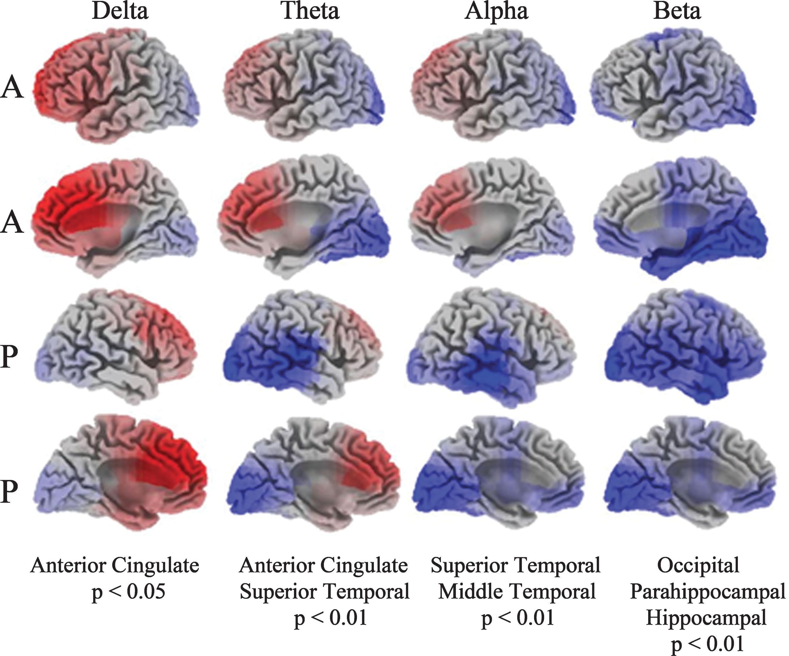 Current density images in Talairach space obtained by sLORETA in PD versus HC cohorts (A: anterior, P: posterior). EEG activity differences are denoted by red (increased activity) or blue (decreased activity).