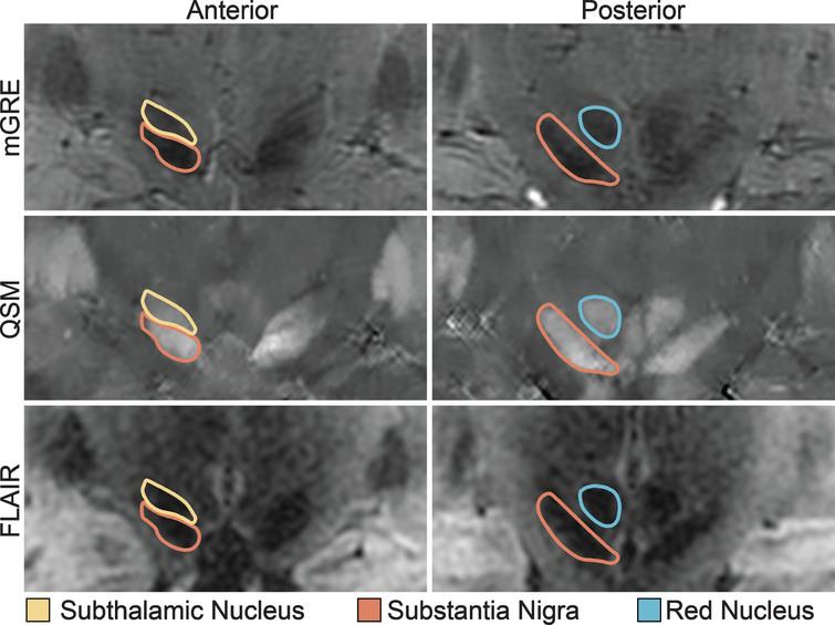Midbrain Nuclei Segmentation. Coronal images of the subthalamic nucleus, substantia nigra, and red nucleus on multi-echo gradient echo (mGRE), quantitative susceptibility maps (QSM), and fluid-attenuated inversion recovery (FLAIR) images. Note the clear separation of the substantia nigra from the subthalamic nucleus on the anterior images.