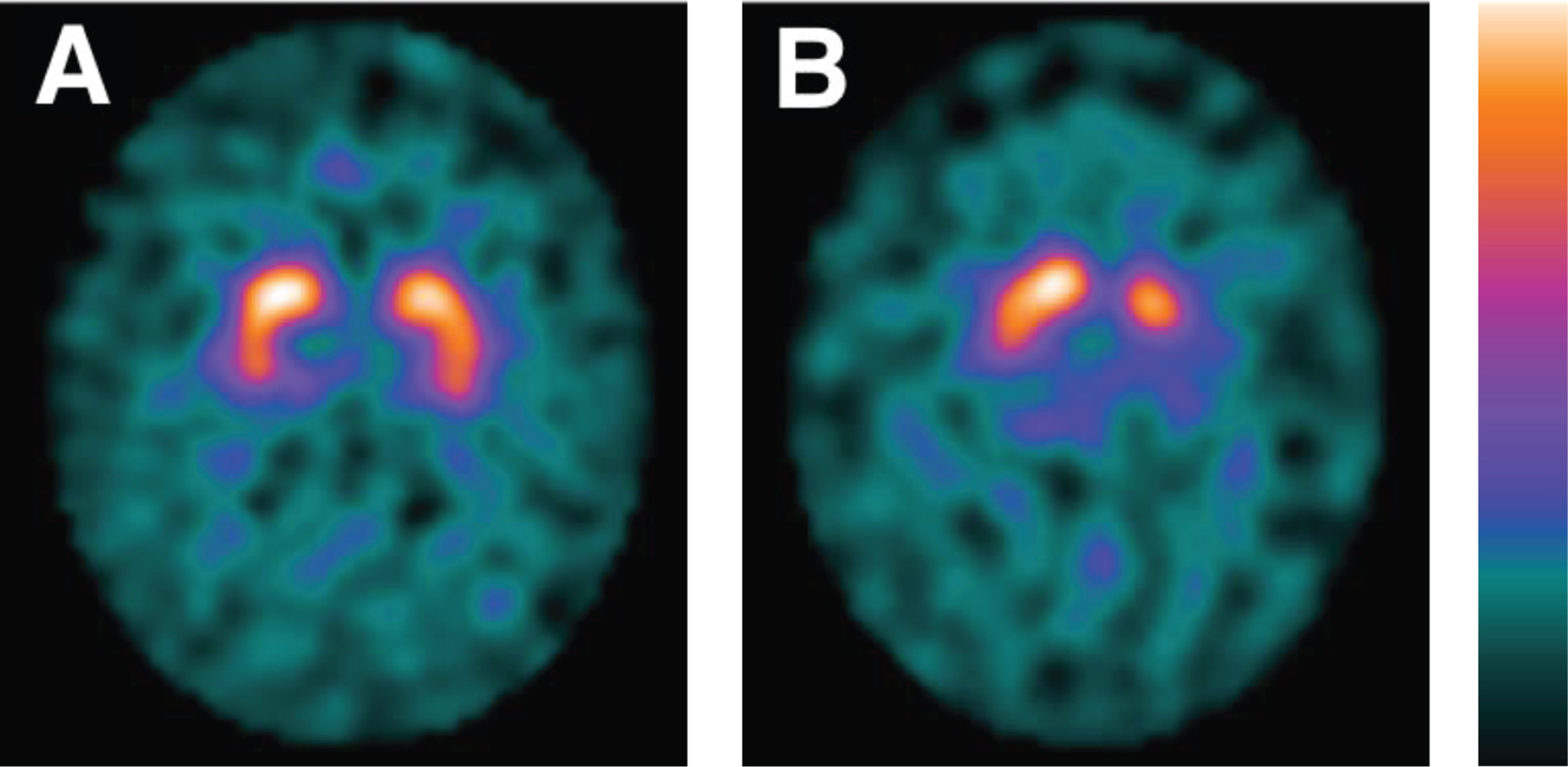 DAT SPECT imaging. Normal (A) and abnormal (B) [123I]FP-CIT SPECT imaging of patients in the LEAP-cohort. Patient A is a 64-year-old male. Patient B is a 63-year-old female. DAT, dopamine transporter; SPECT; single-photon emission computed tomography; LEAP, Levodopa in EArly Parkinson’s disease.