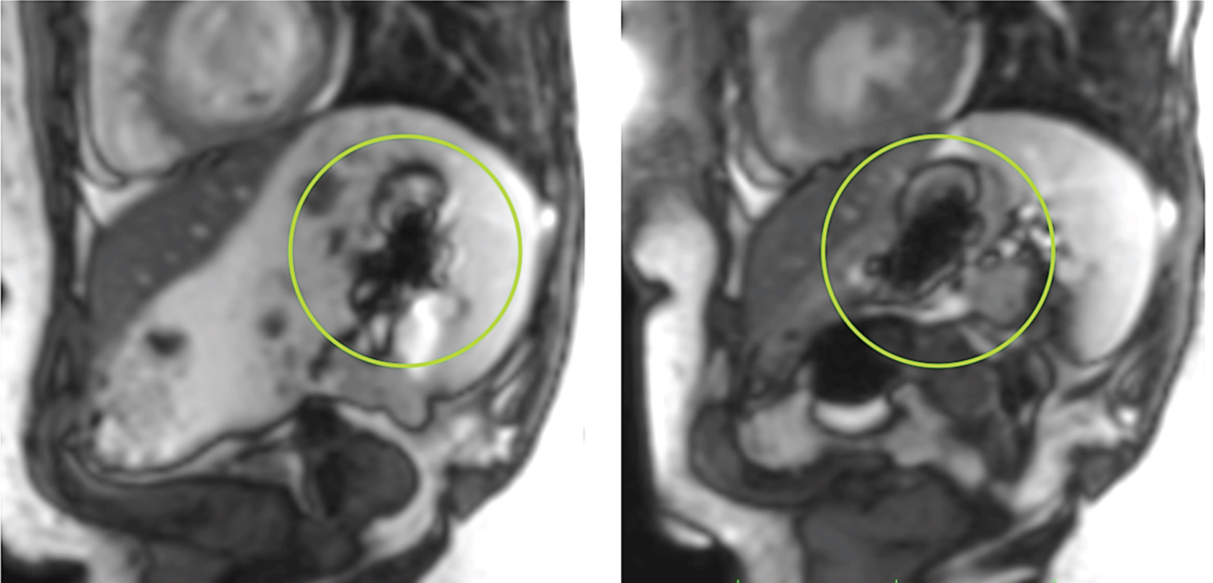 TRUFI sequences (True Fast Imaging with Steady Precession) in the sagittal plane showing the typical artifact (green circle) of the iron-containing capsule.