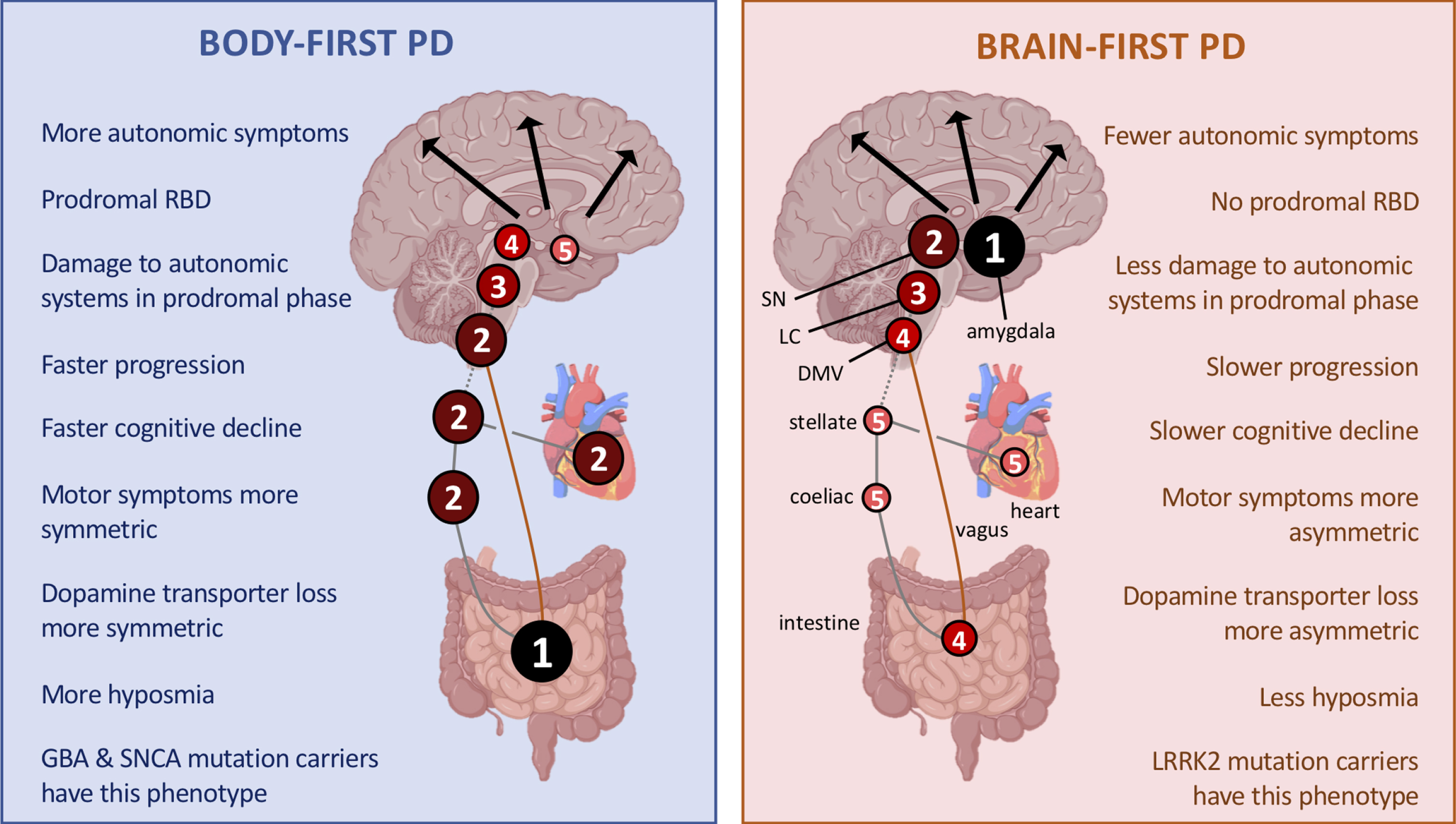 In the body-first subtype of PD, the initial α-synuclein pathology presumably originates in the enteric or autonomic nervous system and spreads to the CNS via the vagus and sympathetic connectome. A brainstem-predominant profile of Lewy pathology follows. These patients develop RBD in the prodromal phase, have more autonomic symptoms, significant hyposmia, faster motor and non-motor progression, and more rapid cognitive decline. When parkinsonism emerges, it is (on average) more symmetric. In the brain-first subtype of PD, the initial α-synuclein pathology presumably originates in the amygdala or in closely connected structures such as the olfactory bulb. An amygdala-predominant profile of Lewy pathology then develops. These patients are RBD-negative in the prodromal phase, have fewer autonomic symptoms, less frequent hyposmia, slower motor and non-motor progression, and less rapid cognitive decline. When parkinsonism emerges, it is most often asymmetric. Different genetic mutations seem to be associated with one or the other of these phenotypes [18]. Both figures illustrate the site of initial α-synuclein pathology (1) and the subsequent spatial-temporal sequence of progressive Lewy pathology (2–5).