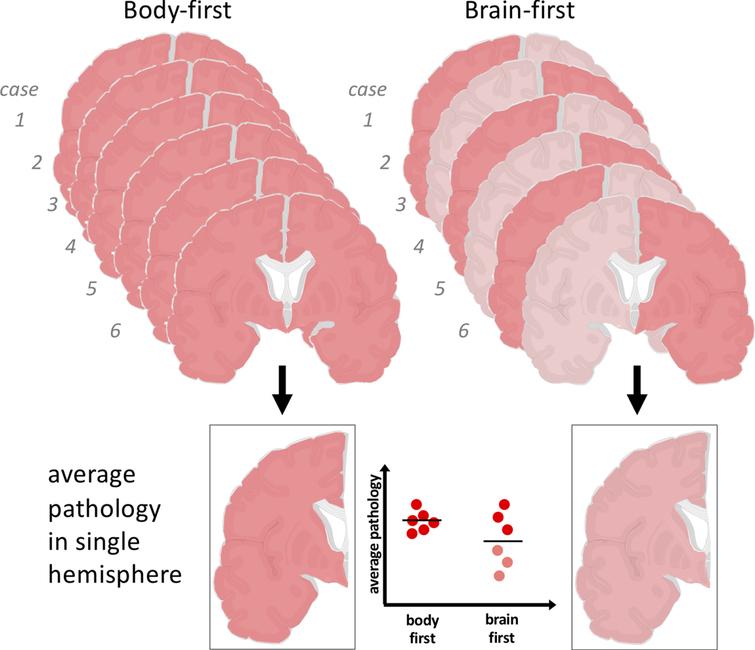 The SOC model predicts that body-first PD shows symmetric α-synuclein pathology, whereas brain-first PD shows asymmetric pathology in the hemispheres. Since only single hemispheres are studied in postmortem studies, this can give rise to the impression that brain-first PD have less Lewy pathology on average. In reality, the most severely affected hemisphere in each brain-first case may show a similar amount of pathology as that seen in both hemispheres of body-first cases.