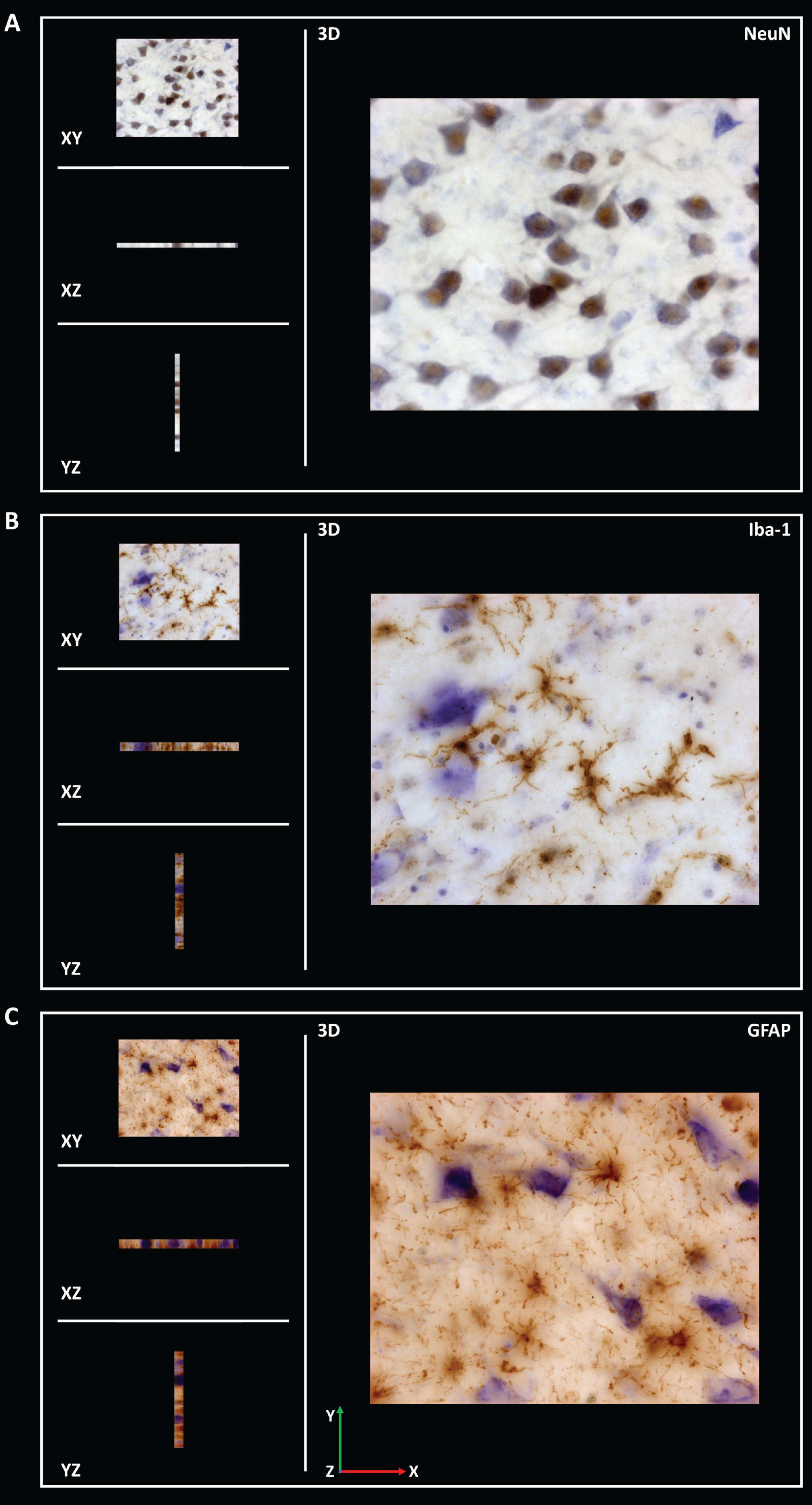 Coronal sections of z-stack of the human hippocampus immunohistochemically stained for NeuN (A), Iba-1 (B) and GFAP (C) were acquired to analyze the infiltration of respective antibodies.