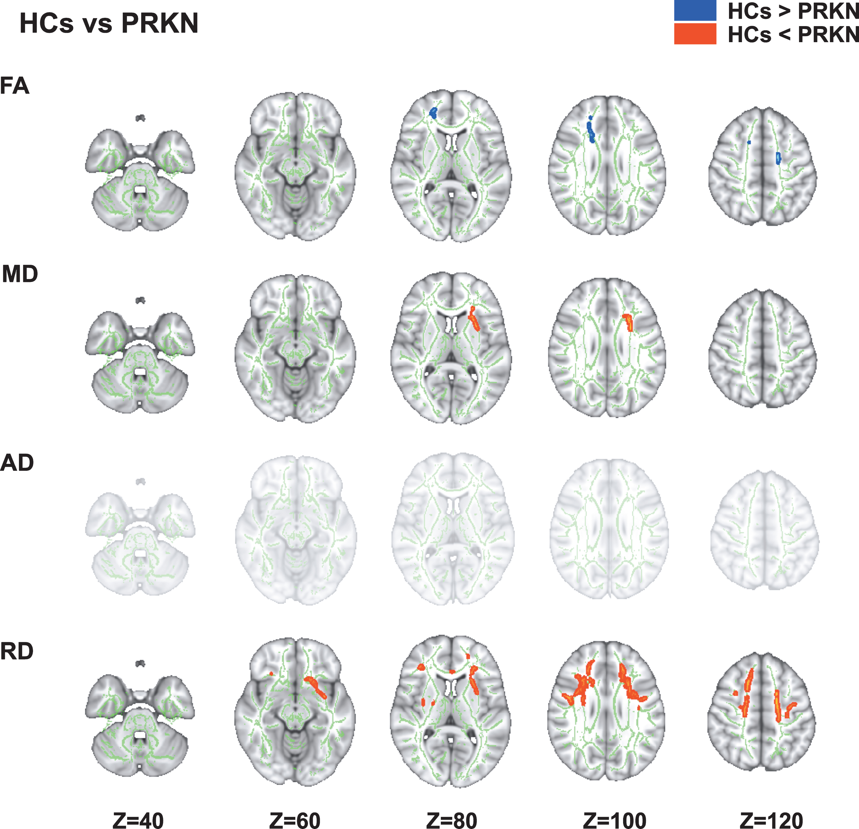 Comparison of diffusion tensor imaging between healthy controls and patients with Parkinson’s disease caused by PRKN mutations. The tract-based spatial statistics analyses show that PRKN patients have significantly lower FA (blue/light-blue voxels; p < 0.05) and significantly higher MD and RD (red voxels; p < 0.05) compared with HCs. FA, fractional anisotropy; HCs, healthy controls; MD, mean diffusivity; RD, radial diffusivity.