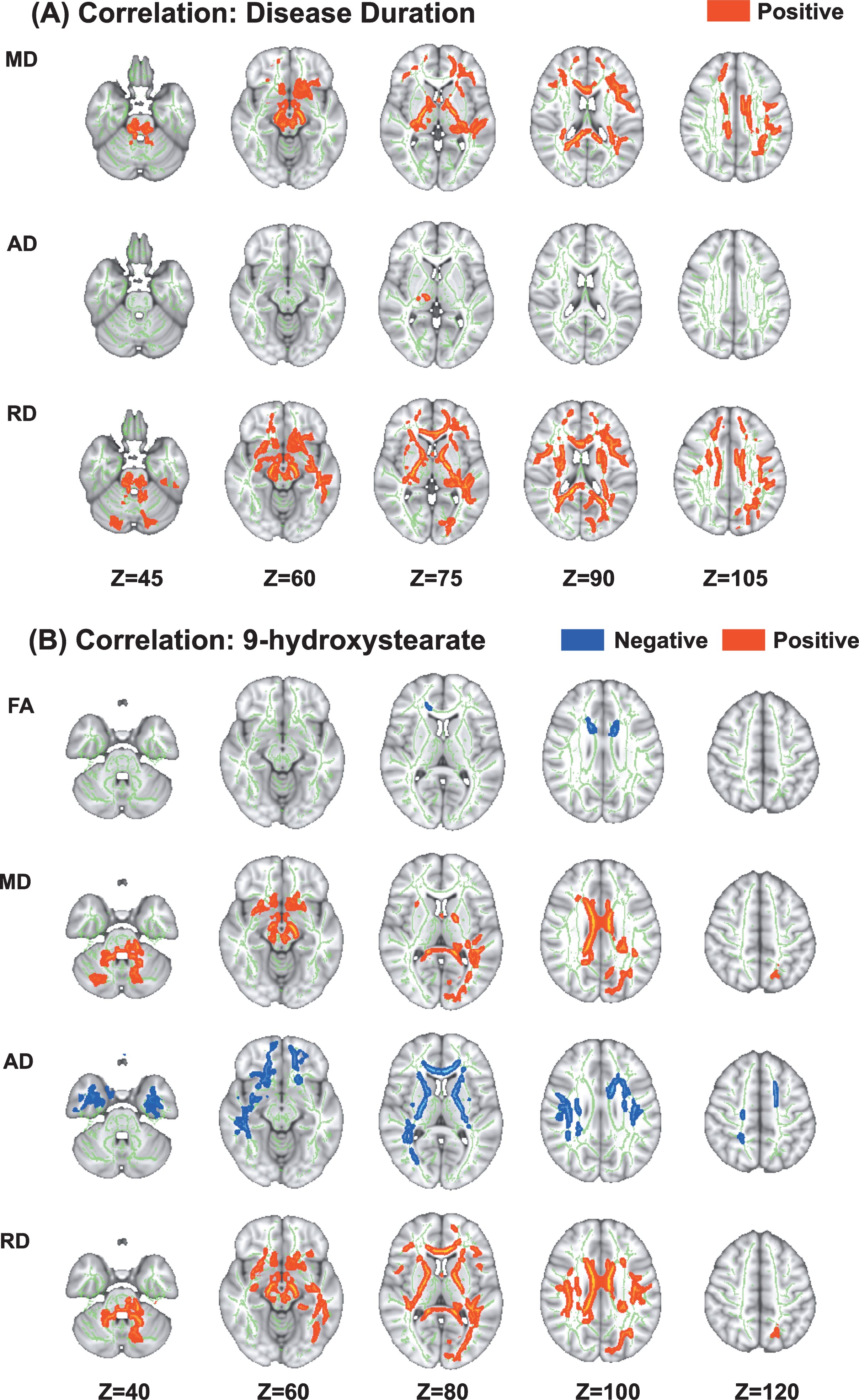 Correlations between diffusion tensor imaging measures and disease duration and 9-hydroxystearate levels in patients with Parkinson’s disease caused by PRKN mutations. Tract-based spatial statistics analyses in PRKN patients revealed a significant positive correlation between disease duration and MD, AD, and RD (A). Additionally, there was a significant negative correlation between the serum levels of 9-hydroxystearate and FA and AD, and a significant positive correlation between the serum levels of 9-hydroxystearate and MD and RD (B). AD, axial diffusivity; FA, fractional anisotropy; MD, mean diffusivity; RD, radial diffusivity.