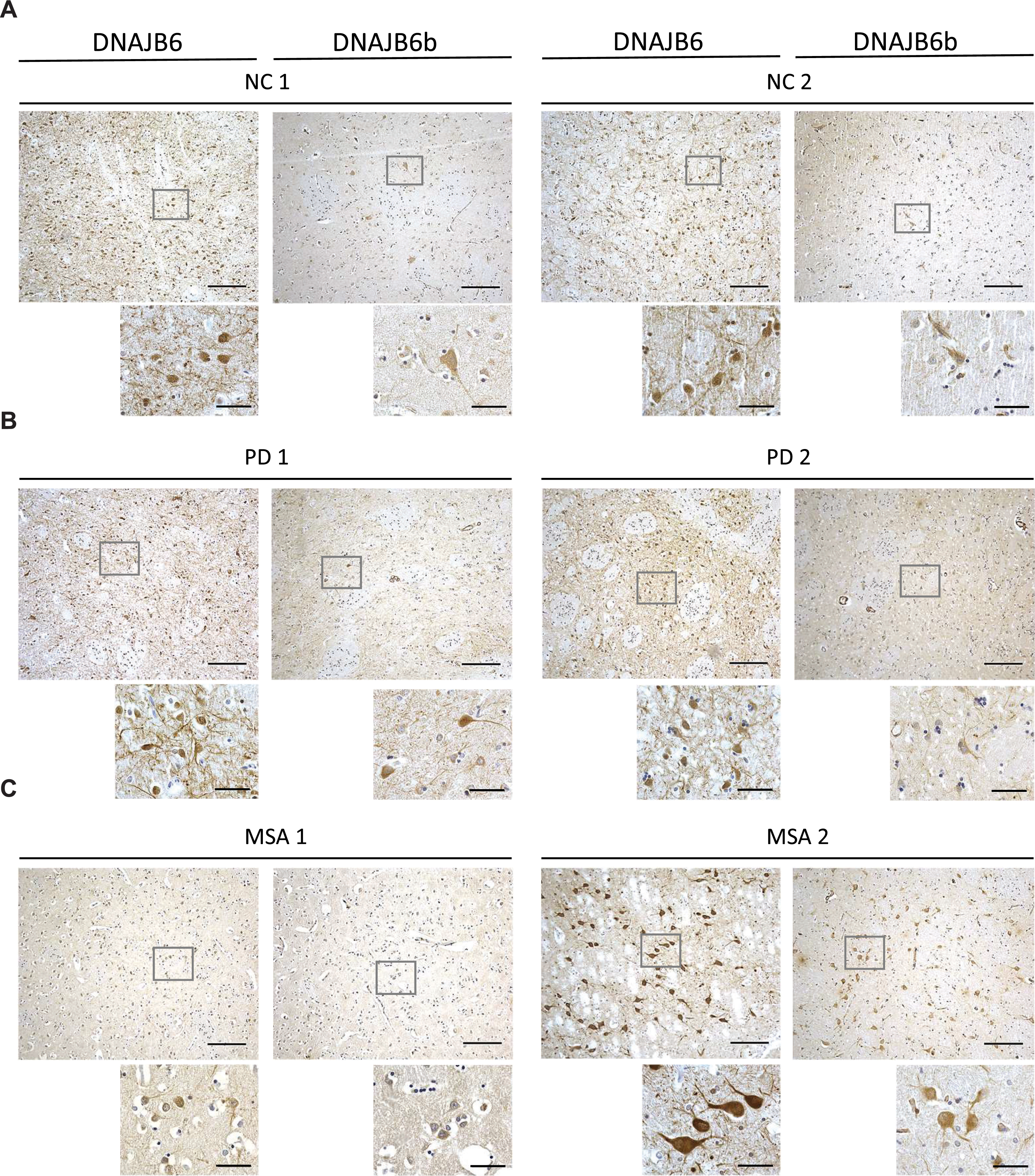 Micrographs showing DNAJB6 and DNJB6B stained sections of the putamen from (A) 2 normal controls, (B) 2 PD patients, and (C) 2 MSA patients at ×10 (large pictures, scale bar = 200αm) and ×60 (small pictures, scale bar = 50αm) magnification.