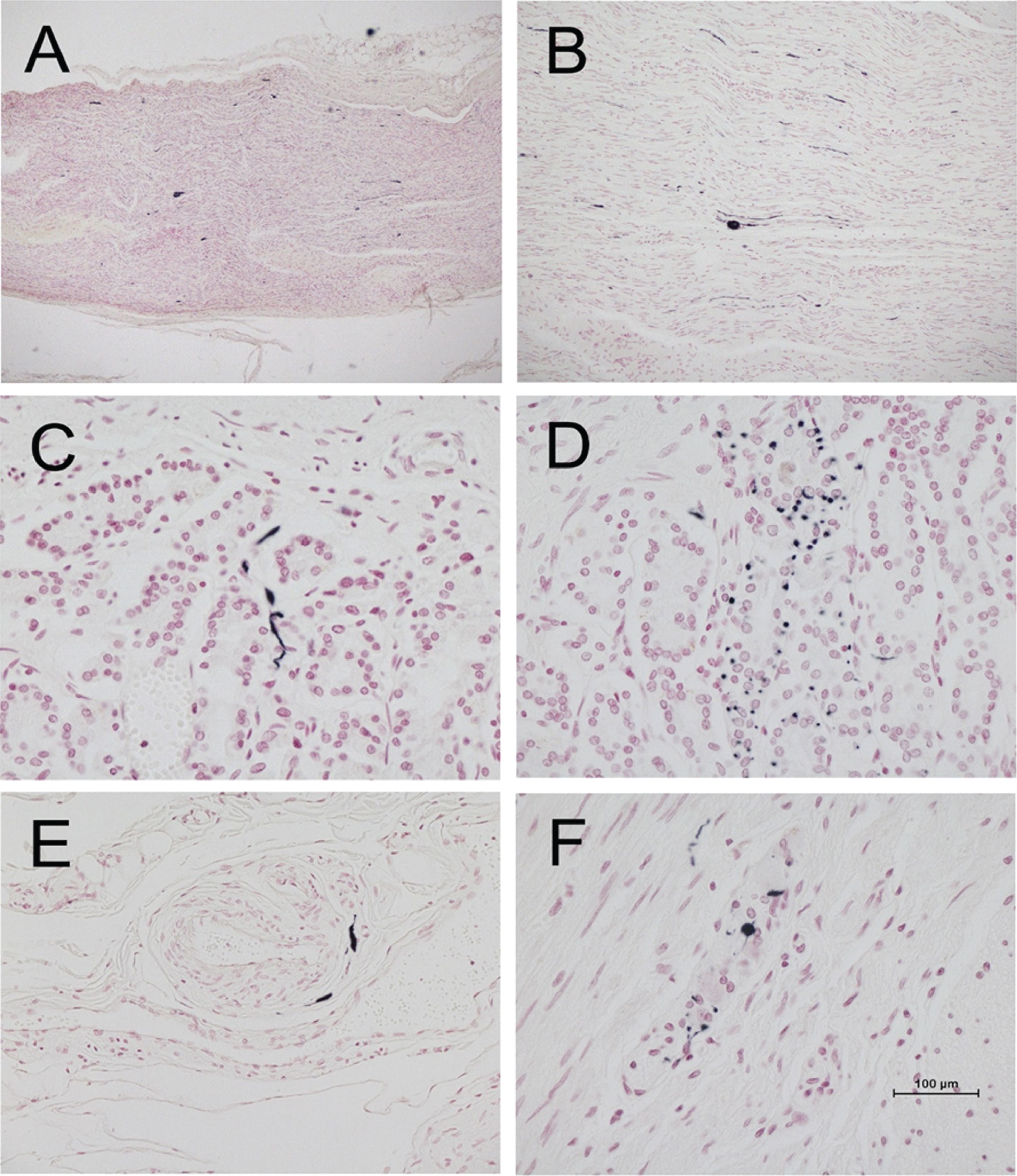 Photomicrographs of vagus nerve and stomach from four different PD subjects, immunohistochemically stained for phosphorylated α-synuclein (black) and counterstained with Neutral Red (red). A and B are longitudinal sections of vagus nerve at low (A) and medium (B) magnification. C and D show short fibers and puncta in the stomach mucosa. E shows short fibers applied to the peripheral surface on an arteriole in the submucosa. F shows puncta within an intermyenteric ganglion. Calibration bar in F represents 100μm for C-F, 400μm for B and 800μm for A.