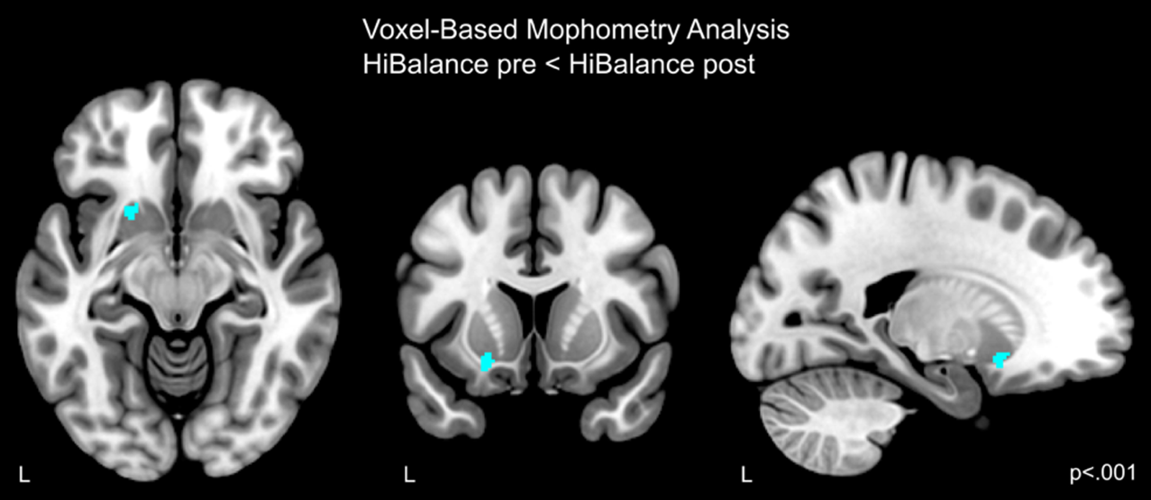 Increased gray matter volume in the HiBalance cohort compared before and after the training. Cluster is uncorrected for multiple comparisons, p < 0.001 with a cluster forming threshold of k = 100 voxels. L left.