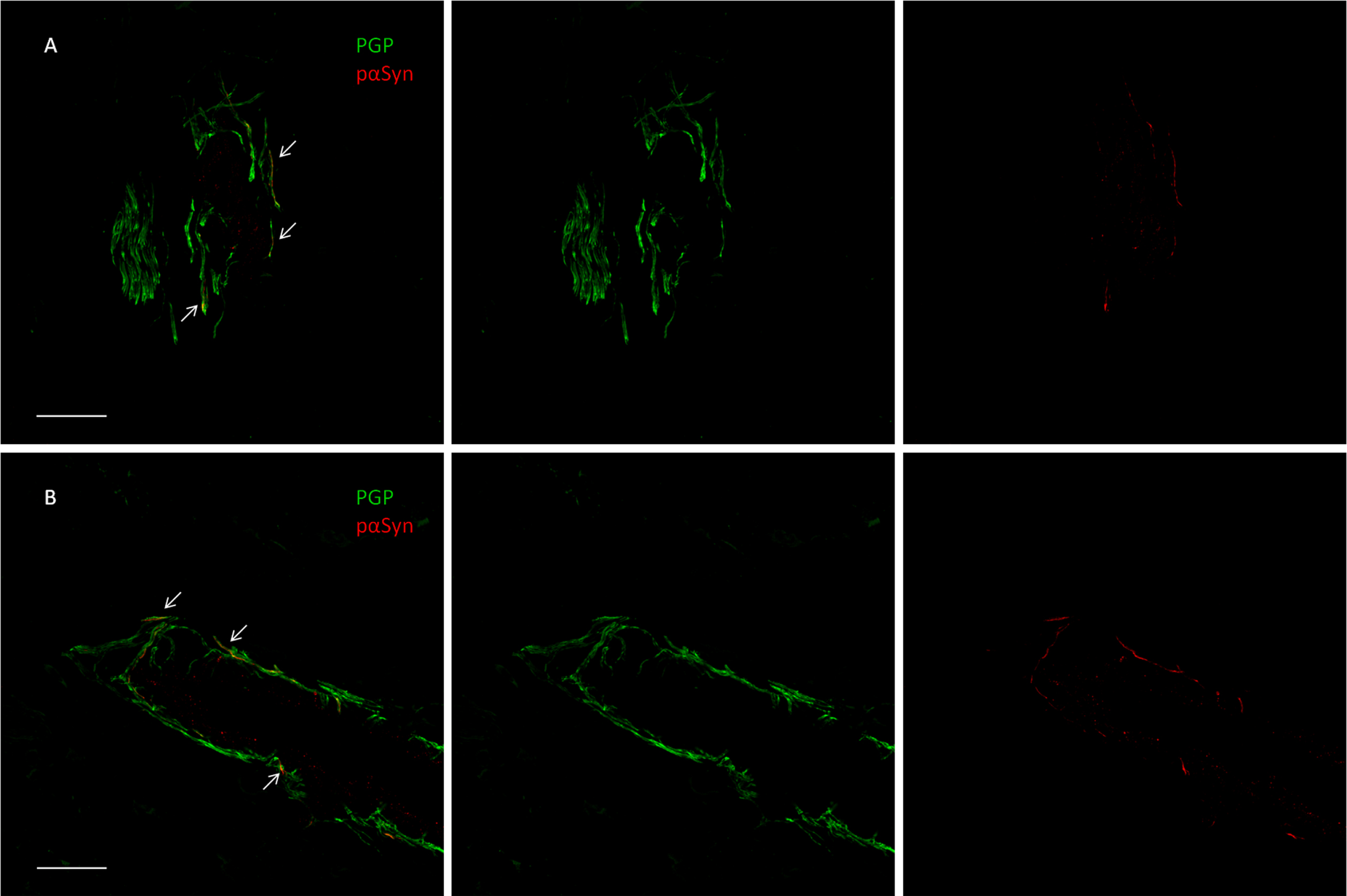 Confocal microscope study of p-syn deposits in a dermal arteriole of a patient with Parkinson disease (A) and in the patient with CBS (B). In both cases, most of the PGP9.5-stained fibers demonstrate the presence of p-syn as neuritic inclusions (arrowheads) shown by the merged image (scalebar 50μM).