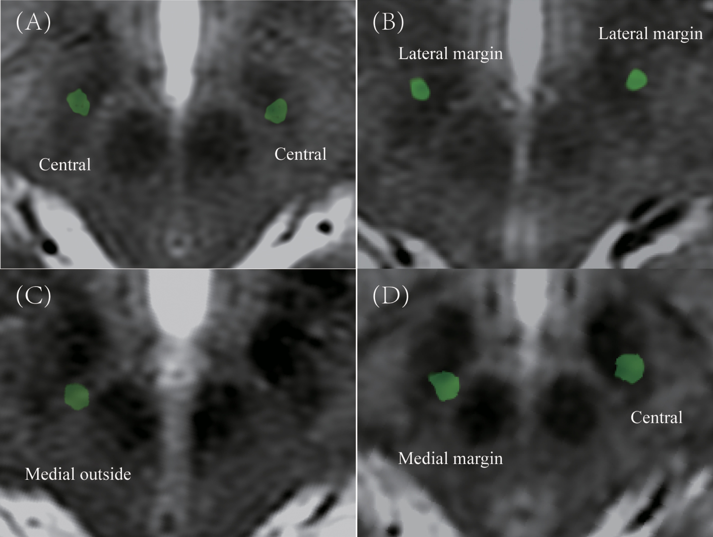 The example of classification in postoperative electrodes position in STN region. A) Central in bilateral STN. B) Lateral margin in bilateral STN. C) Medial outside in right STN. D) Medial margin in right STN and central in left STN.