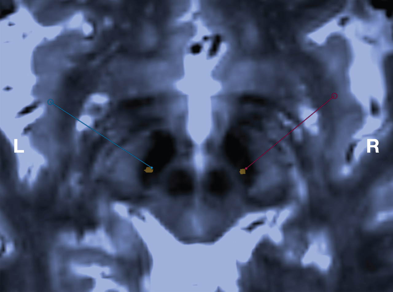 Visualization of the STN, MRI-guided targeting and immediate postoperative verification of final electrode position. Axial stereotactic 3D T2-weighted SPACE MRI at 3.0 T through the inferior portion of the STN. This sequence is used for both targeting the STN and localization of the Leksell Vantage frame. Blue and red bullets are indicating the patient-specific intended target at the left and right side respectively, with the corresponding lines indicating the planned trajectories. The orange metal artefacts indicate the position of the final electrodes of the same patient, verified by co-registering an immediate postoperative stereotactic CT to the 3D T2-weighted SPACE MRI.