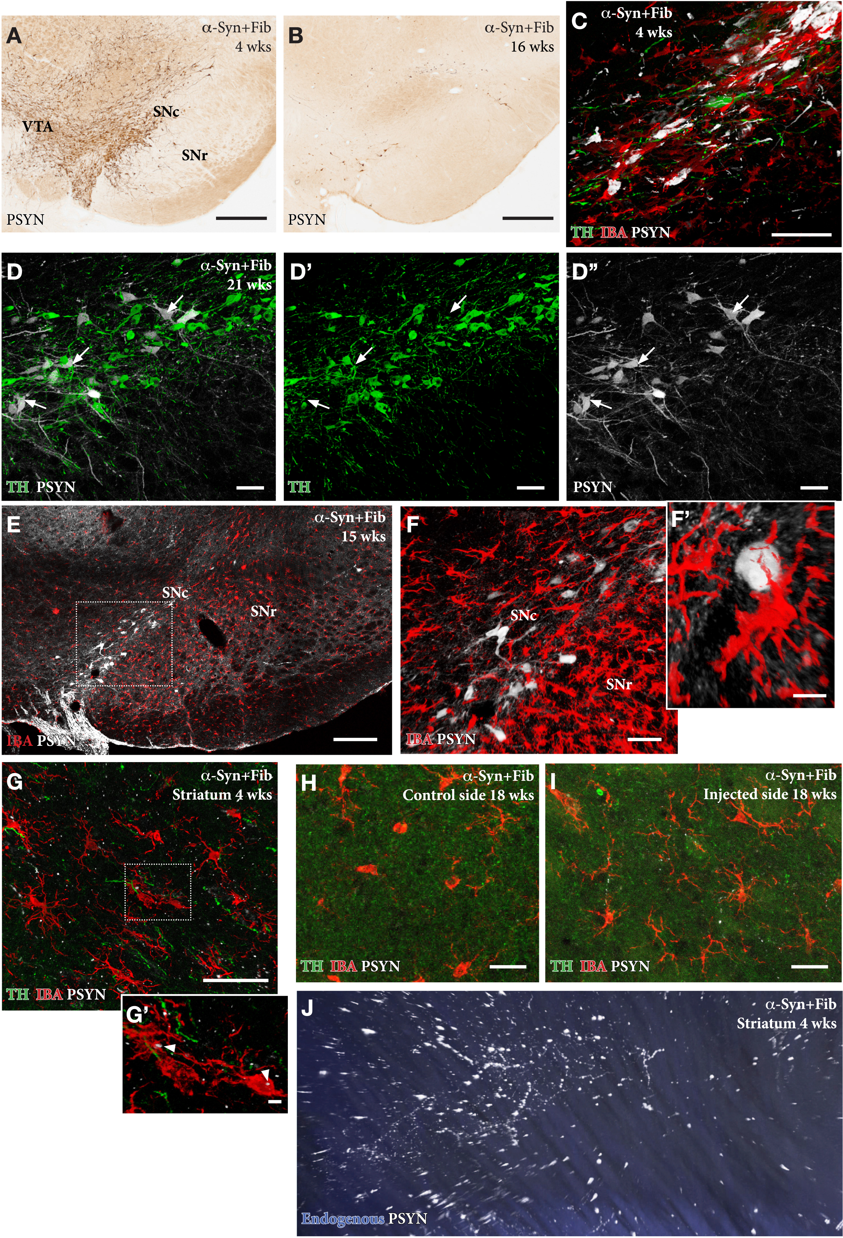 In the AAV/PFF treated rats prominent p-syn+pathology develops early, already at 4 weeks, in the DA neurons (A, C), as well as in their axons and terminals in the striatum, as illustrated in the Supplementary 3D movie captured by light-sheet microscopy (Supplementary Movie S1; still image in J). This is accompanied by an Iba1 + microglial response (F, G, H) and downregulation of TH (arrows in D-D''), that is maintained also at longer time-points. The p-syn pathology declines over time (B, E, F) which is in line with the progressive loss of the affected DA neurons. A notable feature of the microglial response is the appearance of p-syn+inclusions inside the Iba1 + microglia (arrow heads in G'). Scale bars: 500μm (A,B), 50μm (C,D,F,G,H,I), 200μm (E), 10μm (F',G').