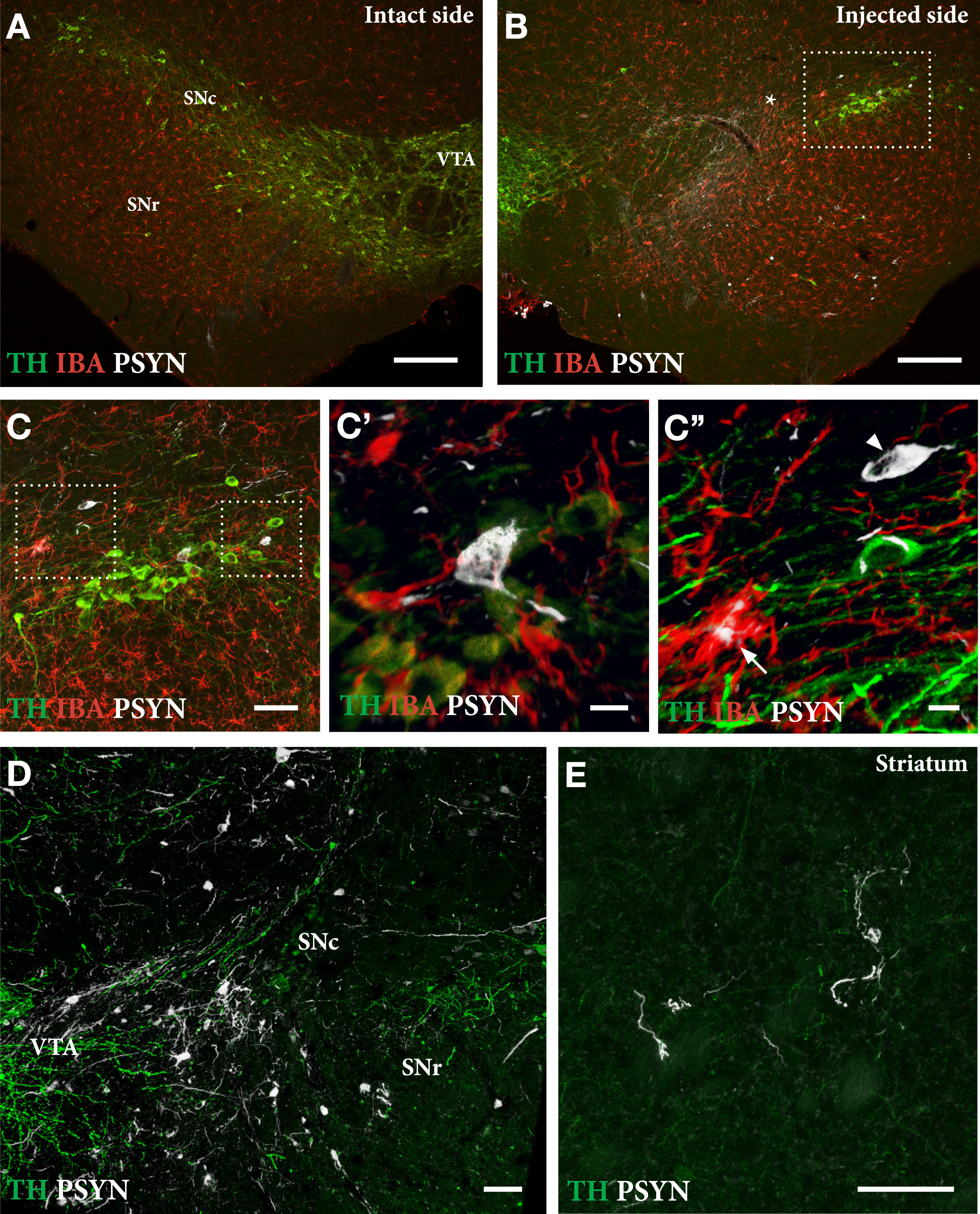 Extent of TH+nigral cell loss (A, B) and p-syn+pathology seen in nigral DA neurons (C, D) and striatal terminals (E) in mice treated with a single intranigral injection of AAV/PFFs. The framed square in B is shown at higher magnification in C, and the squares in C are shown at higher magnification in C' and C''. At this stage, 12 weeks post-injection, the ongoing p-syn pathology and microglial response is similar in magnitude and appearance to that seen in long-term AAV/PFF treated rats (see Fig. 4). As in rats, TH downregulation (arrowhead in C'') and p-syn+inclusions inside activated Iba1 + microglia (arrow in C'') occur also in the mouse SynFib model. Scale bars: 200μm (A,B), 50μm (C,D,E), 10μm (C',C''). Unpublished data.