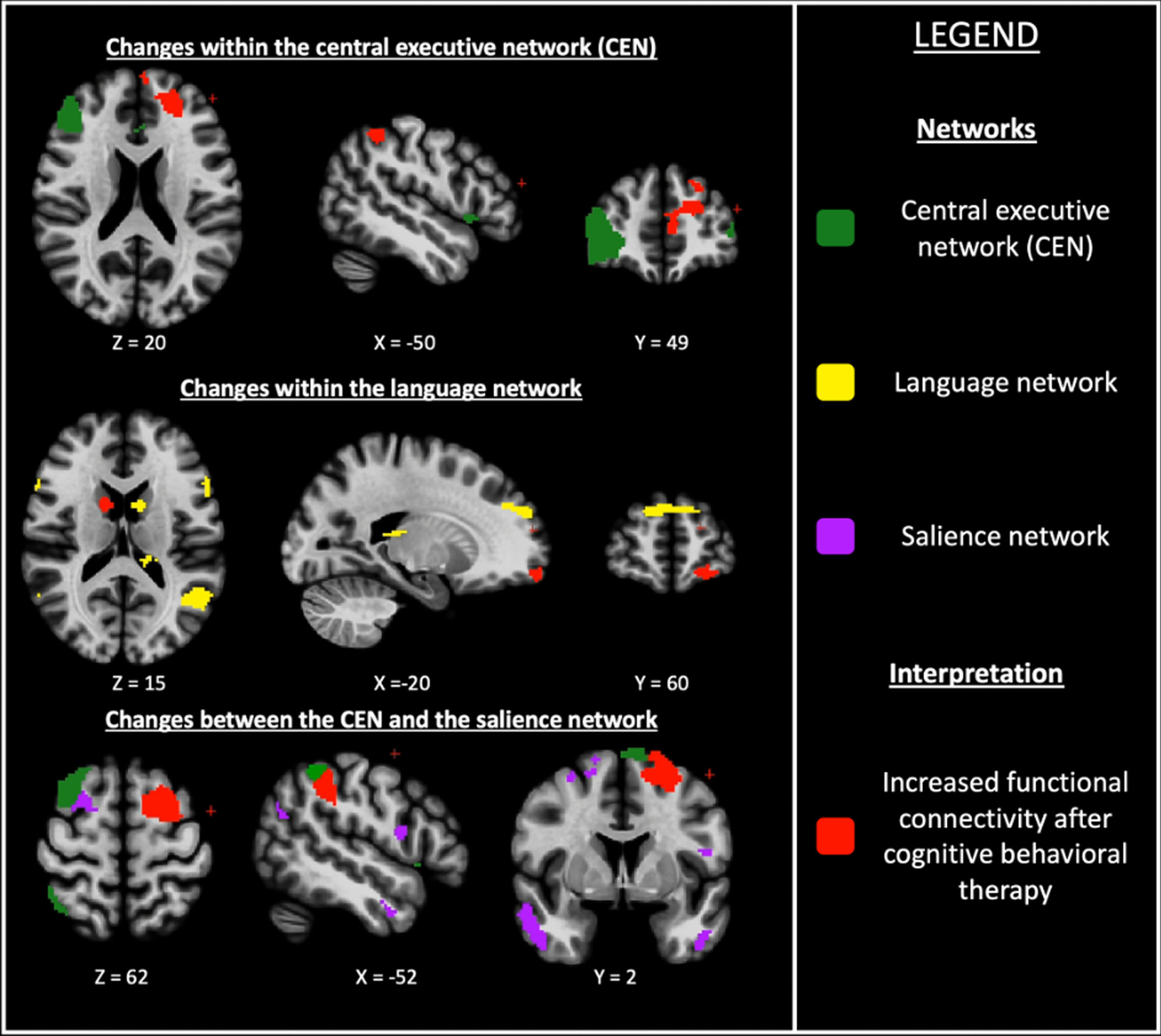 Changes within and between resting-state functional networks in cognitive behavioral therapy group compared with clinical monitoring only group for anxiety in Parkinson’s disease. Axial, sagittal and frontal view; (z, x, y) = coordinates in the MNI space (Montreal Neurological Institute).