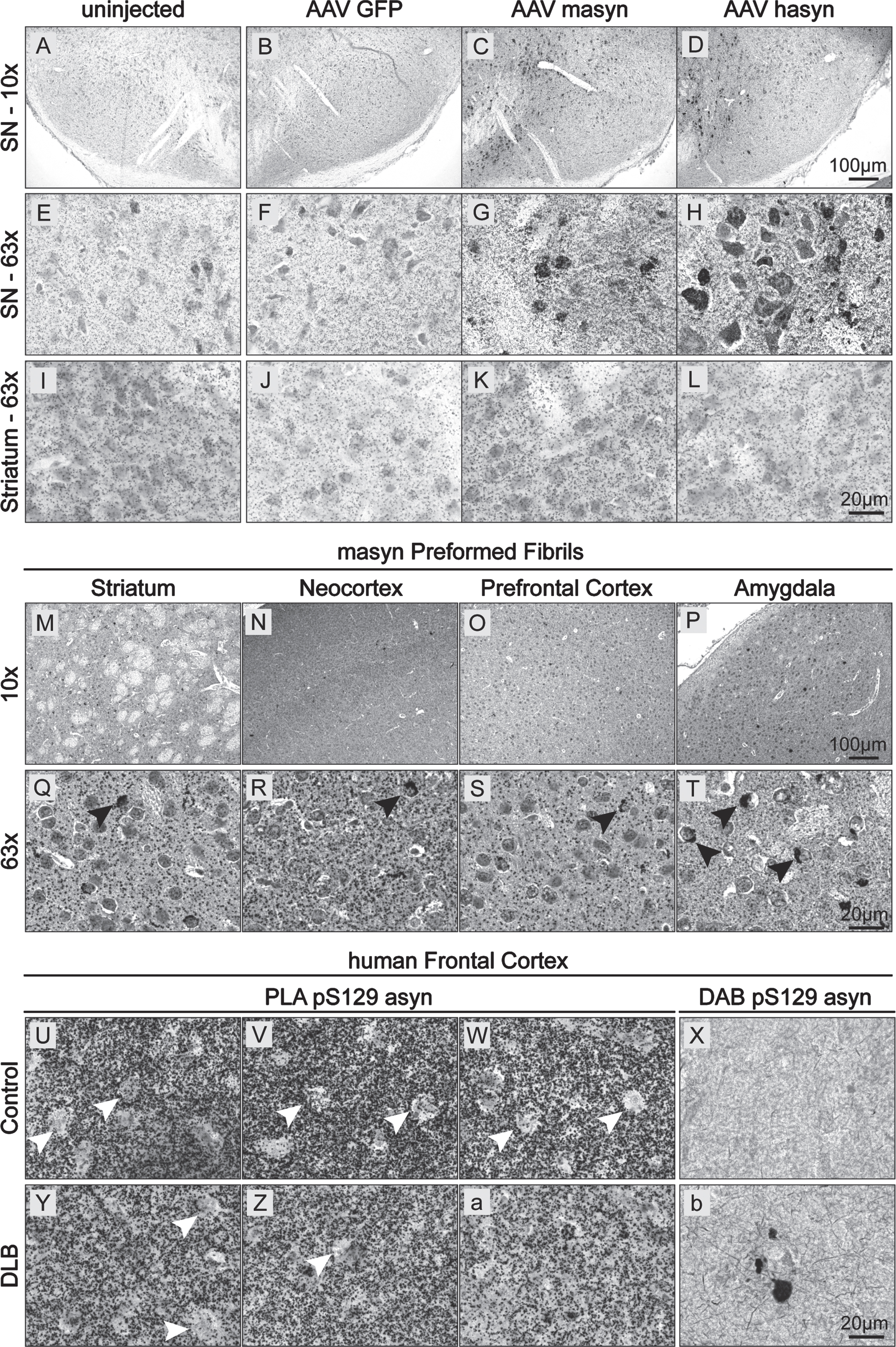BF-PLA used on sections from animal models and human frontal cortex. A–L) Mice were injected with AAV expressing either GFP (B,F,J), mouse asyn (masyn) (C,G,K) or human asyn (hasyn) (D,H,L). Four weeks after injection, the brains were fixed, cut into 30μm thick sections, and stained using the BF-PLA. Uninjected sides were used as a baseline control (A,E,I). Images were taken either with 10x (A–D) and 63x (E–L) magnification. (M–T) Mice were injected with asyn PFF into the striatum. One month after injection, the mice brains were fixed, embedded in paraffin, cut into 6μm thick sections, and stained using the BF-PLA. Images of striatum (M,Q), neocortex (N,R), prefrontal cortex (O,S) and amygdala (P,T) were taken at 10x (M–P) and 63x (Q–T) magnification. Accumulation of pS129 asyn staining in cell bodies indicated by black arrows (Q–T). U-b) Human frontal cortical sections from a healthy control (Case 5) (U–X) and a DLB patient (Case 1) (Y-b) were acquired from ADRC and stained using the BF-PLA protocol. Images were taken at 63x magnification. The monoclonal pS129 asyn antibody, 81A, was used singly to confirm the presence and absence of LBs in the DLB patient tissue and healthy control tissue, respectively (X,b).