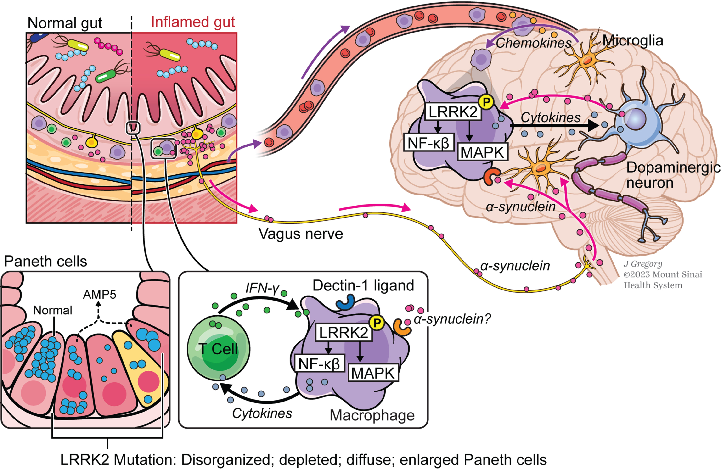 The gut-brain axis in Parkinson’s disease (PD). In this concept of PD pathogenesis, macrophages in the gut lamina propria are induced by secreted pro-inflammatory cytokines in individuals carrying gain-of-function LRRK2 variants that express increased levels of activated LRRK2; stimulation of cells by α-synuclein from enteric nerves may also occur at this site but this is still unproven. Macrophages thus stimulated that gain entry into the circulation are attracted into brain tissue by chemokine-secreting microglia and in the brain tissue are induced to produce pathogenic inflammatory cytokines by as yet undefined stimuli, possibly including α-synuclein once again; these cytokines cause or aggravate neural degeneration. Also depicted are small intestinal Paneth cells whose function is regulated in part by LRRK2; thus, LRRK2 variants that affect this function and adversely regulate the composition of the gut microbiome may lead to PD by promoting gut inflammation.
