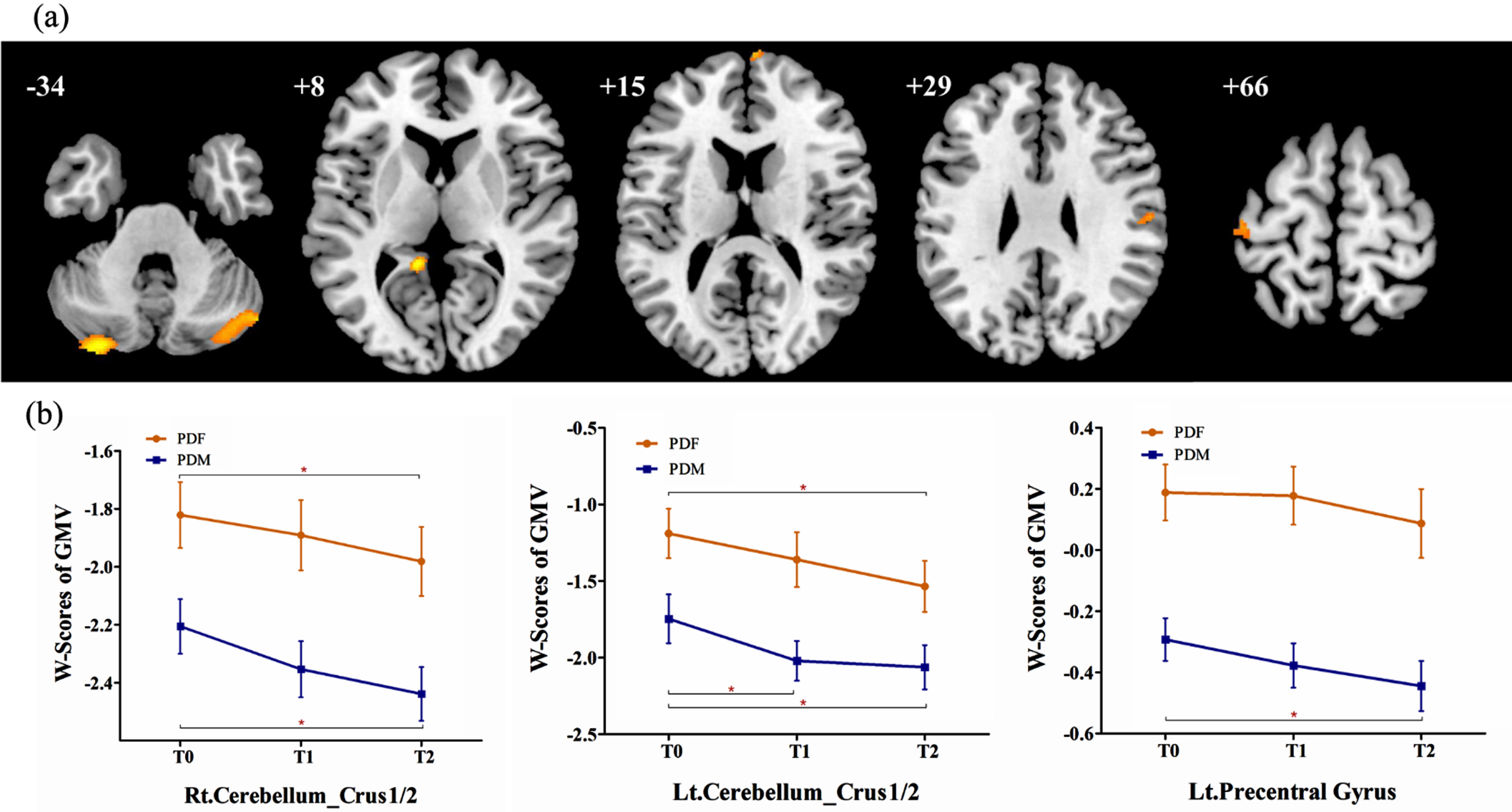 (a) Brain regions showed significantly reduced GMV in males than in females in PD group 1. (b) In PD group 2, significantly reduced GMV in males than in females was observed in the bilateral cerebellum_crus 1/2 and left precentral gyrus, while no significant sex difference in longitudinal changes was observed. PDF, female PD patients; PDM, male PD patients; T0, baseline; T1, 12-month follow-up; T2, 24-month follow-up; Lt., left; Rt., right; GMV, grey matter volume. *p < 0.05.