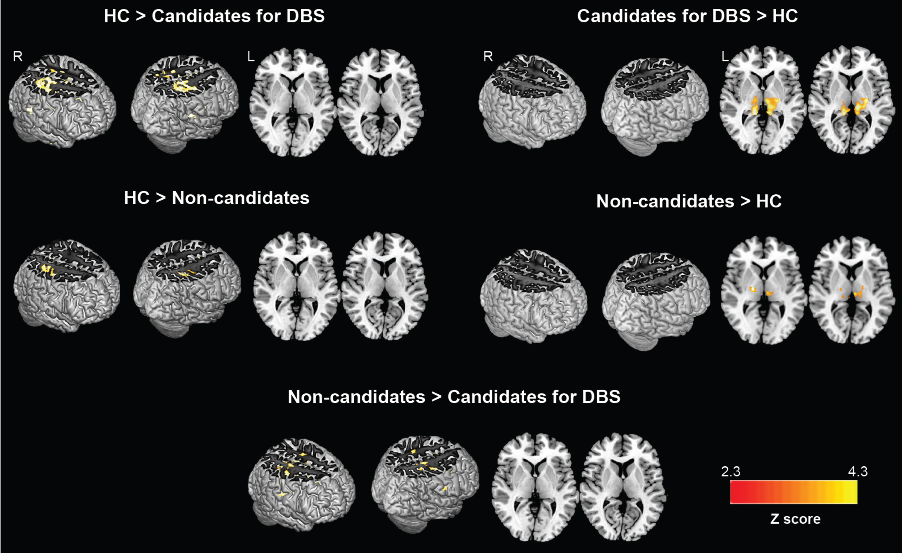 Seed-based functional connectivity analysis. Resting-state functional connectivity of the bilateral STN seed region among PD groups and healthy controls. Results are overlaid on the Montreal Neurological Institute template in neurological convention, displayed at p < 0.05 family wise error corrected for multiple comparisons (with age and sex variables as covariates), implementing the threshold-free cluster enhancement. Colored bar represents Z values.