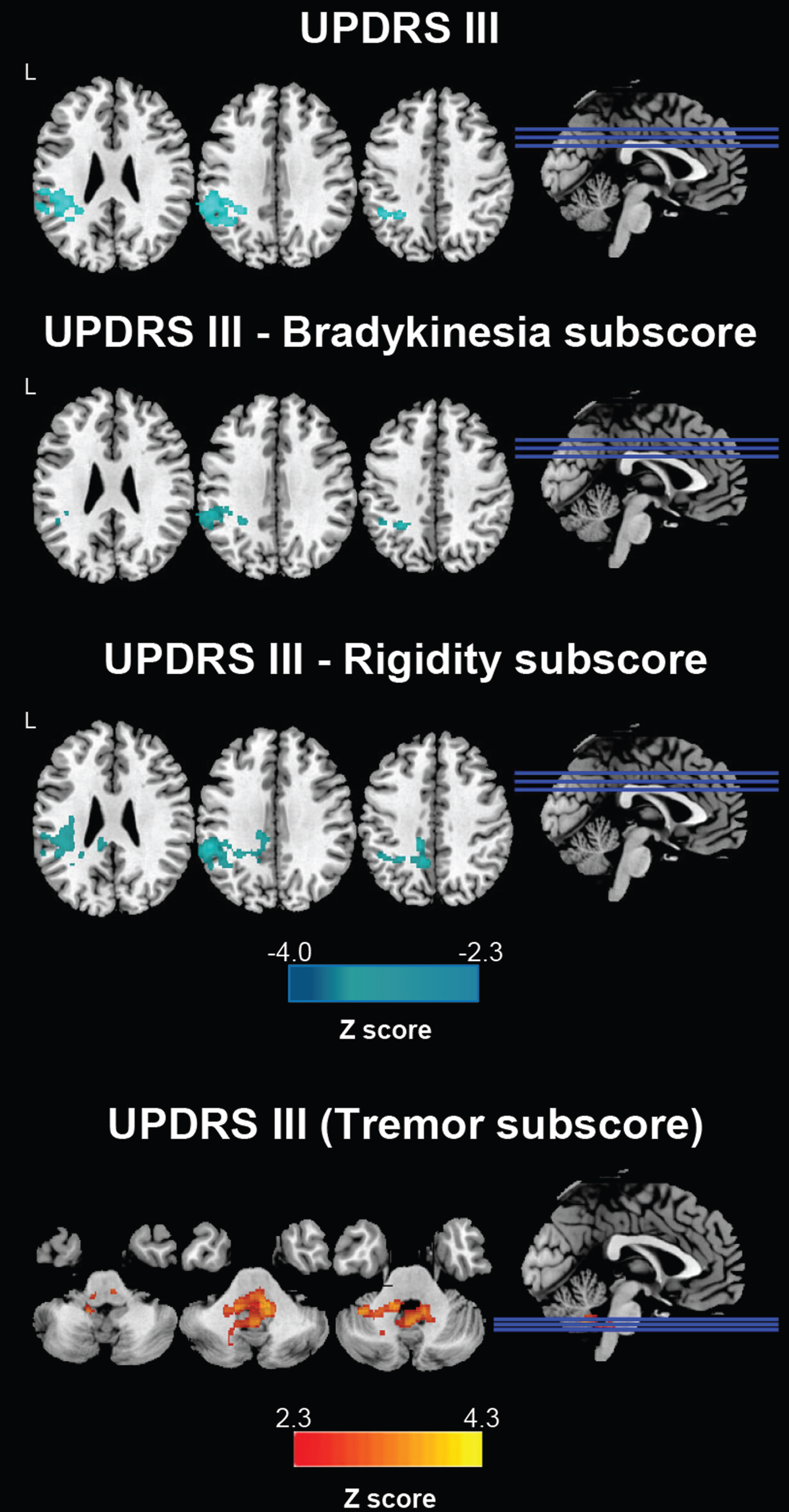 Correlations between STN functional connectivity and UPDRS-III scores in PD candidates for DBS. Clusters showing significant correlation between STN functional connectivity and UPDRS III values are marked in blue (Z negative correlation) and red (Z positive correlation) colors. DBS, candidates for deep brain stimulation; STN, subthalamic nucleus.