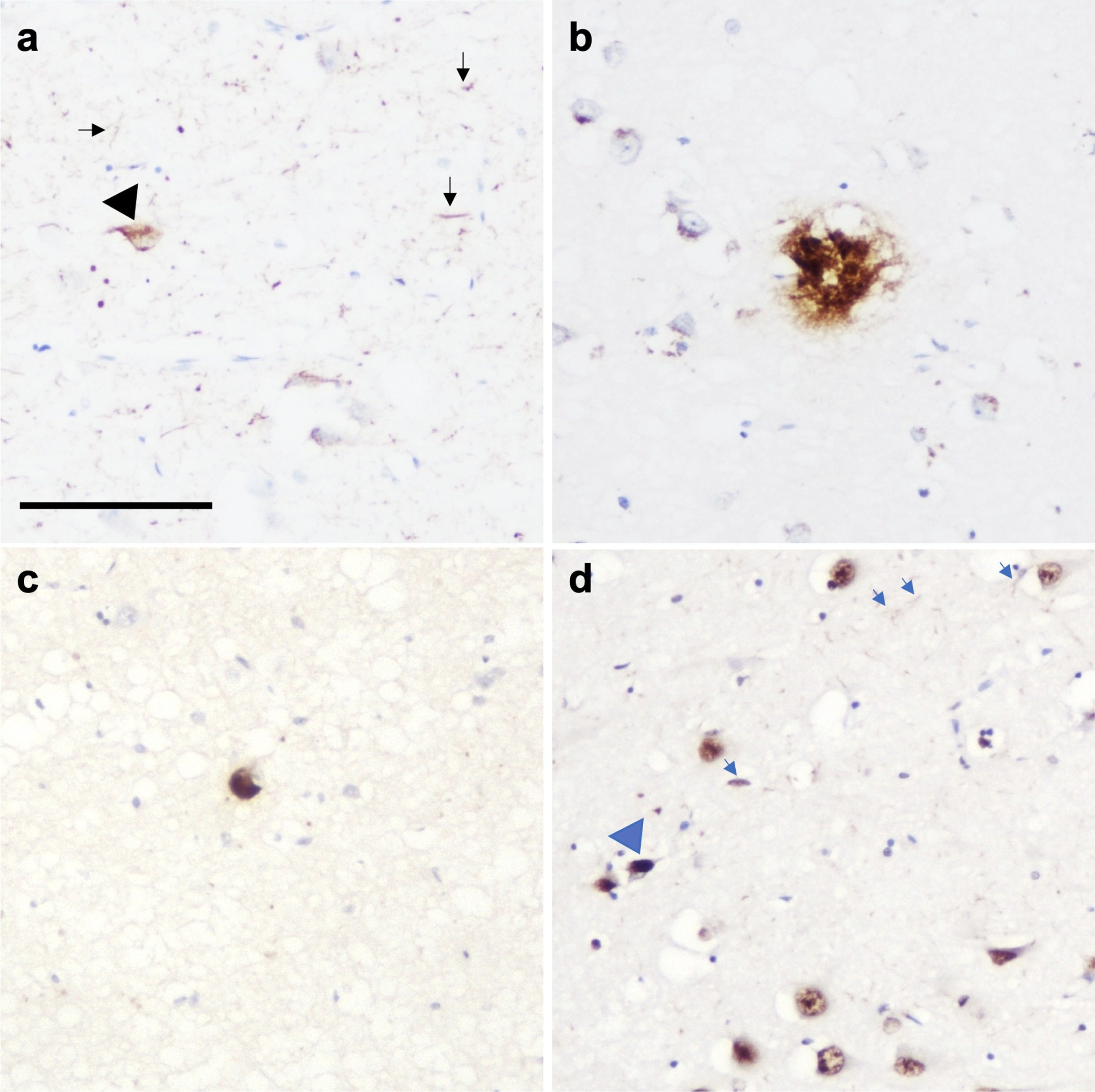 Photomicrograph demonstrating the presence of multiple pathologies in CA1 region of the hippocampus in a PD case. (a) Neurofibrillary tangles (black arrowhead) and neuropil threads (black arrows), (b) amyloid-β plaque, (c) Lewy body, and (d) TDP-43 neuronal intranuclear inclusion (blue arrowhead) and dystrophic neurites (blue arrows). Scale bar represents 100μm.