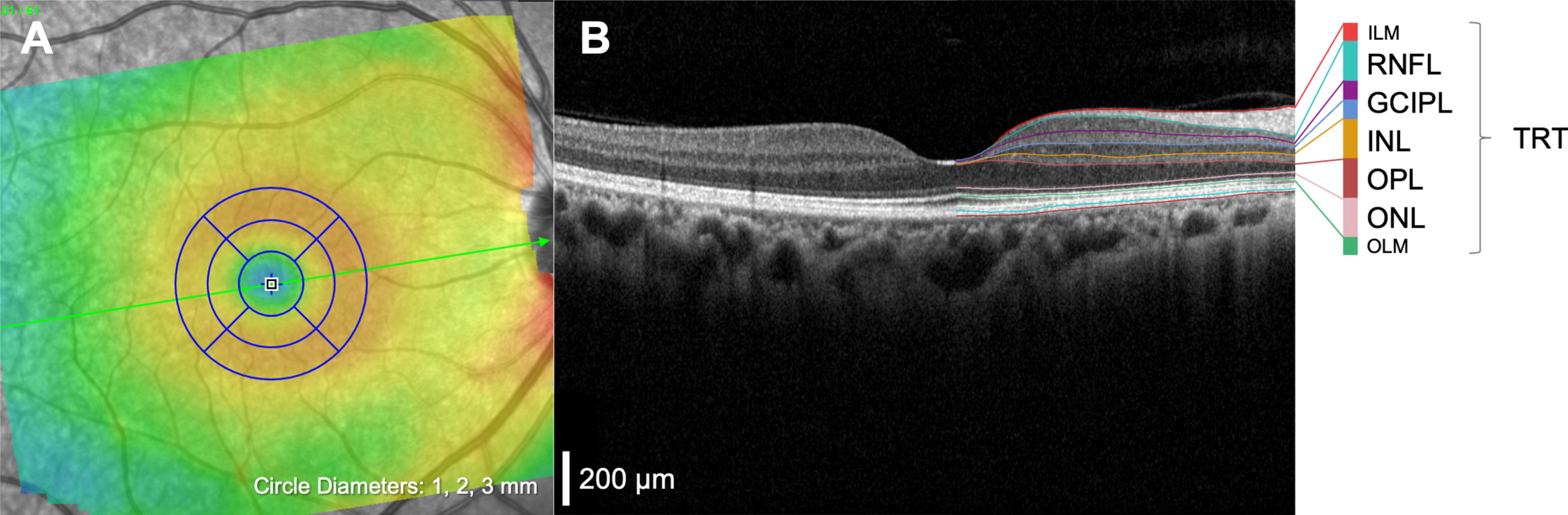 Example macular OCT scan. A) A macular volume scan with an Early Treatment Diabetic Retinopathy Study [ETDRS] grid overlaid for retinal layer thickness profile analysis. B) Corresponding cross section [green line on panel A] illustrating the automatic segmentation of retinal layers: retinal nerve fiber layer, RNFL; ganglion cell inner plexiform layer, GCIPL; inner nuclear layer, INL; outer plexiform layer, OPL; outer nuclear layer, ONL and total retinal thickness, TRT. TRT is a measurement that spans from the inner limiting membrane (ILM) to the outer limiting membrane (OLM). Scale bar, 200μm.