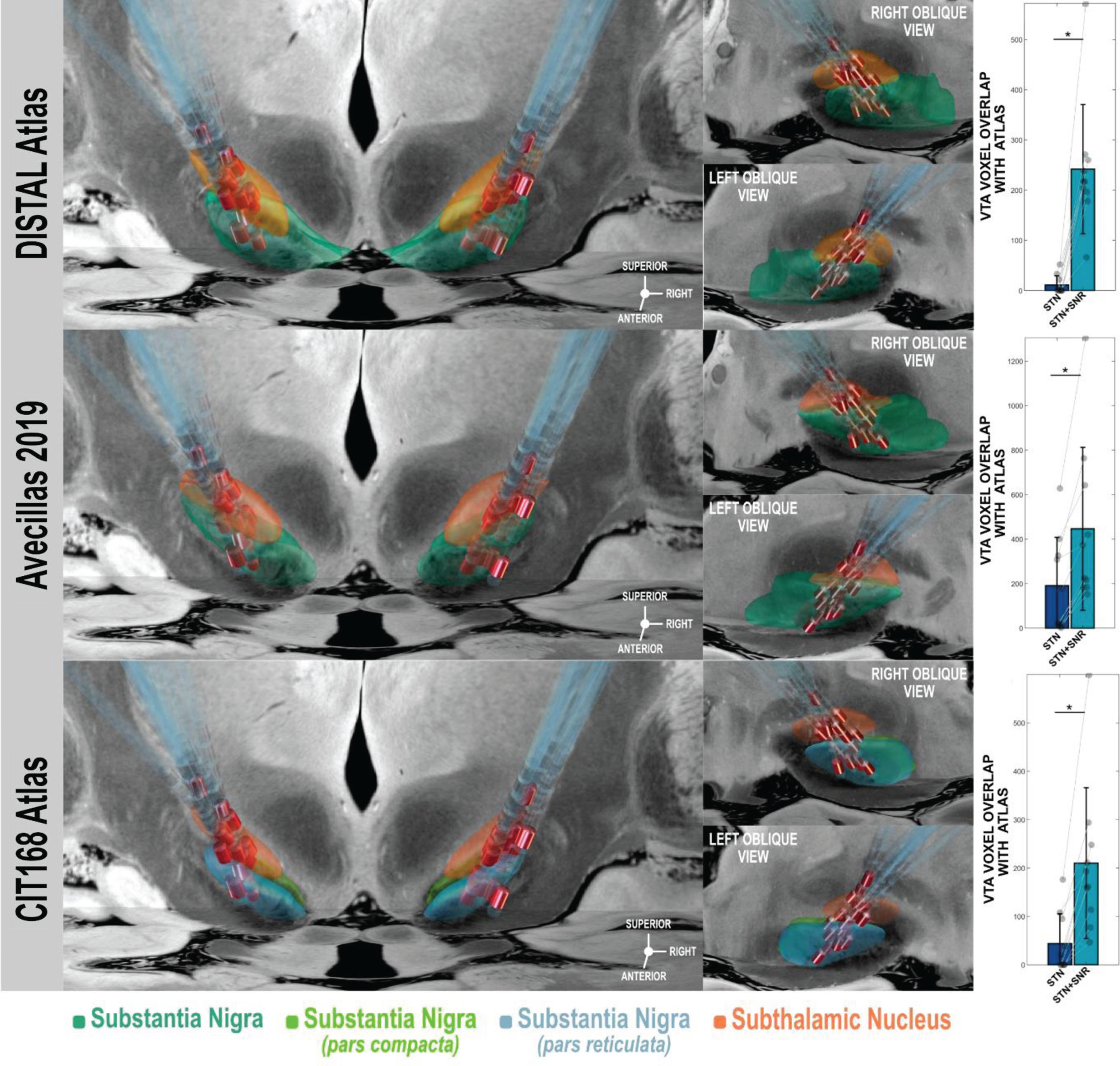 Left Panel: 3D-visualization of DBS leads of the cohort in coronal view (left) and sagittal views on right and left STN (orange) and SN (turquoise) relative to target structures as represented by DISTAL Atlas [32], Avecillas atlas [34], and CIT168 atlas [35]. Contacts active in the STN+SNr-DBS condition are highlighted in red. Note the position of the most ventral active contacts within or in direct vicinity of the SNr atlas representations. Atlas structures and leads are superimposed on a slice of 7 Tesla MRI of ex vivo human brain at 200 micron resolution [61]. Right Panel: Bar charts showing numerical overlap of voxels of stimulation volumes for stimulation conditions STN and STN+SNr-DBS with corresponding atlas representation of substantia nigra of DISTAL Atlas [32], Avecillas atlas [34], and CIT168 atlas [35]. Voxel numbers account for both hemispheres. * indicates differences of overlapping voxels were significant (p < 0.05).