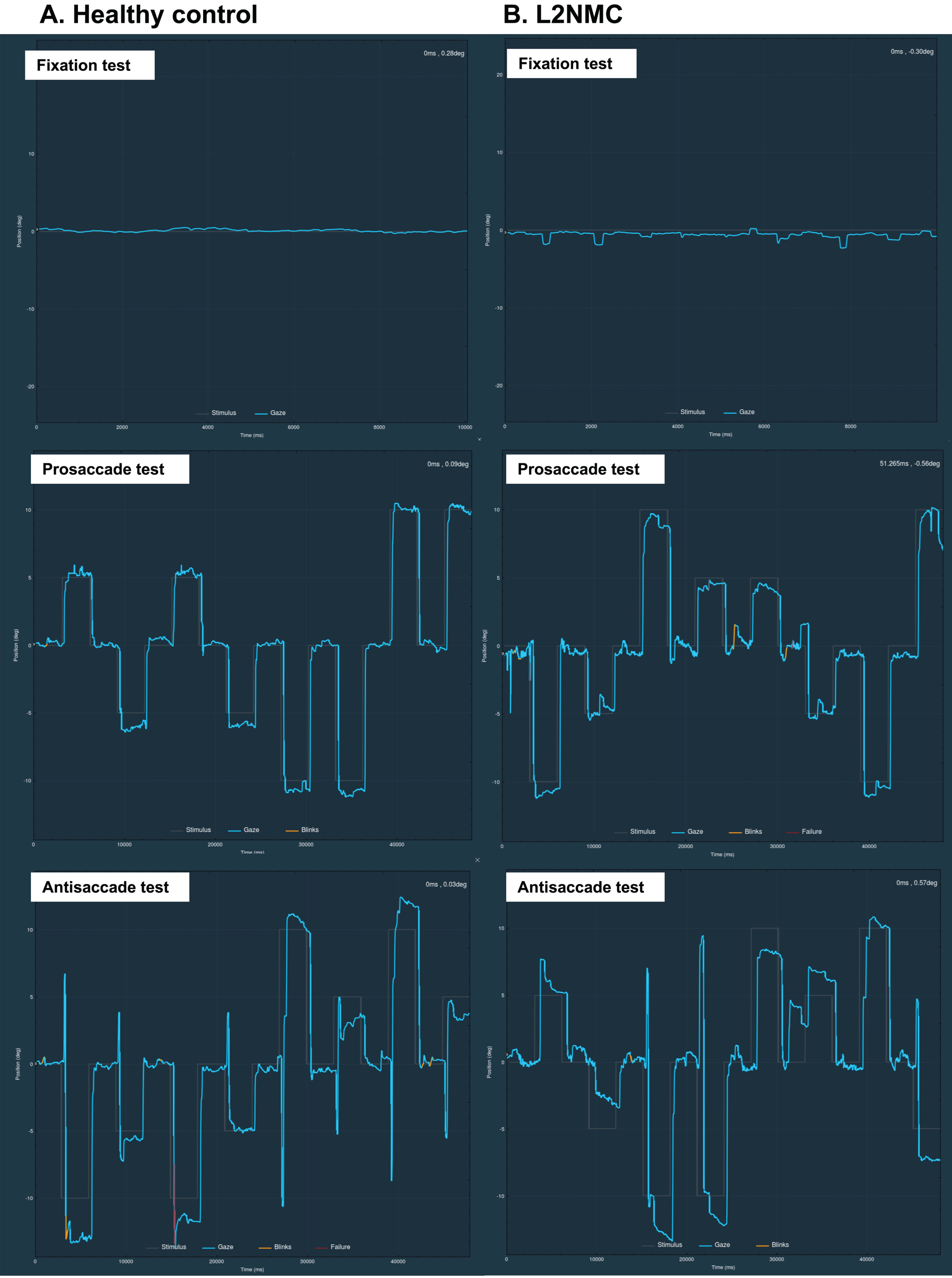 Clinical examples of fixation and vertical prosaccade and antisaccade tests in a healthy control (A) and in a LRRK2 nonmanifesting carrier (L2NMC) (B). In the L2NMC, frequent SWJs during fixation and slow corrections of antisaccade errors in the antisaccade test can be appreciated. In the ordinate axis, 0 indicates the center of the screen, positive values the superior part, and negative values the inferior part of the screen. Blue lines represent the participant’s ocular movement. Gray lines indicate the expected gaze location, which corresponds to the target position in the prosaccade test, and to the opposite position of the target in the antisaccade test. Blinks are marked in yellow and pupil detection failure (usually also due to blinks) in red. deg, degrees; ms, milliseconds.