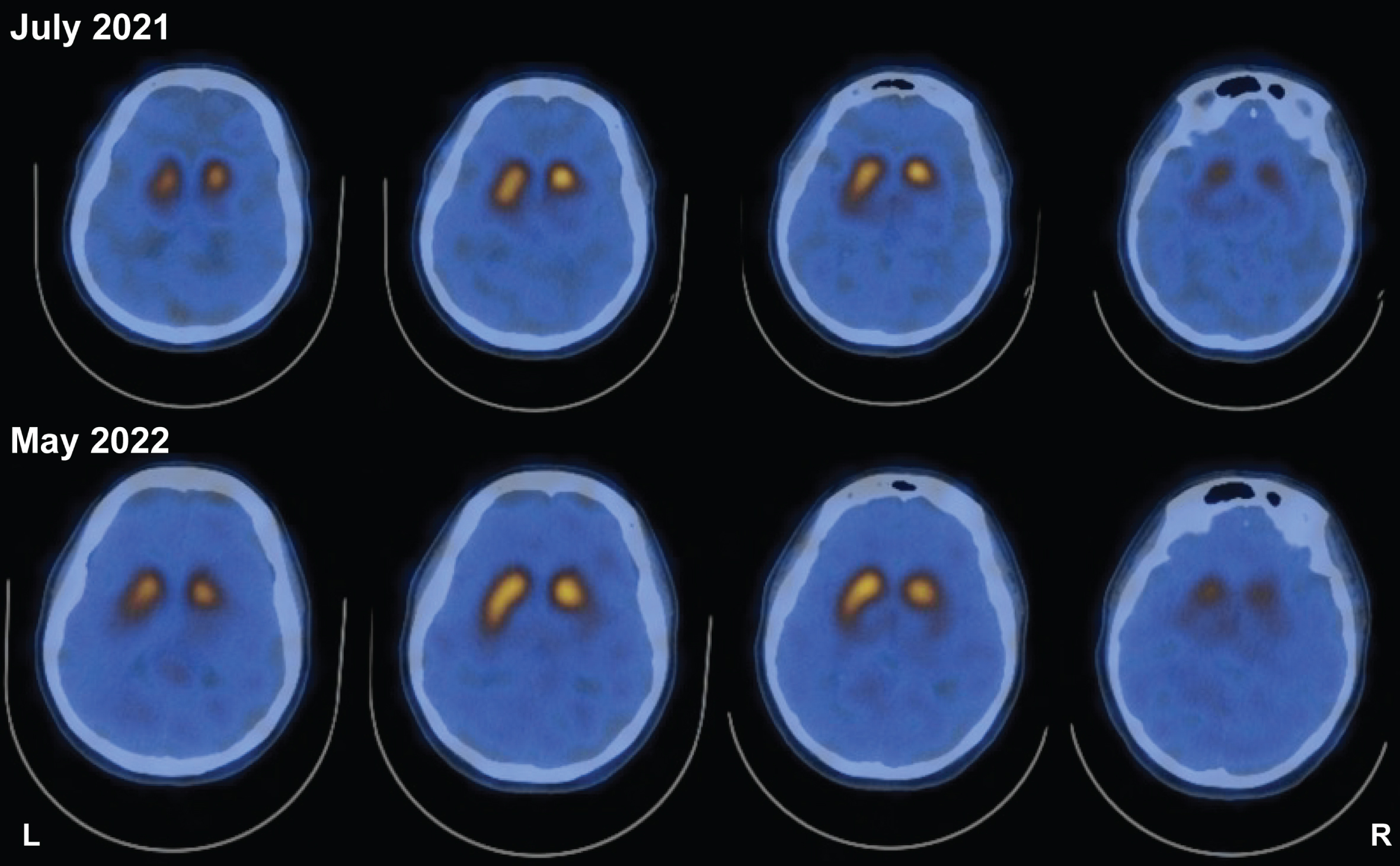 DaTscan reveals left-side asymmetry in striatal DAT binding and is not qualitatively different 11 months after initial scan. Study showing reduced striatal DAT binding both at study initiation and ∼11 months (10 months and 28 days) afterwards. Despite worsened symptoms and clinical presentation, two scans 11 months apart do not reveal changes in asymmetry.