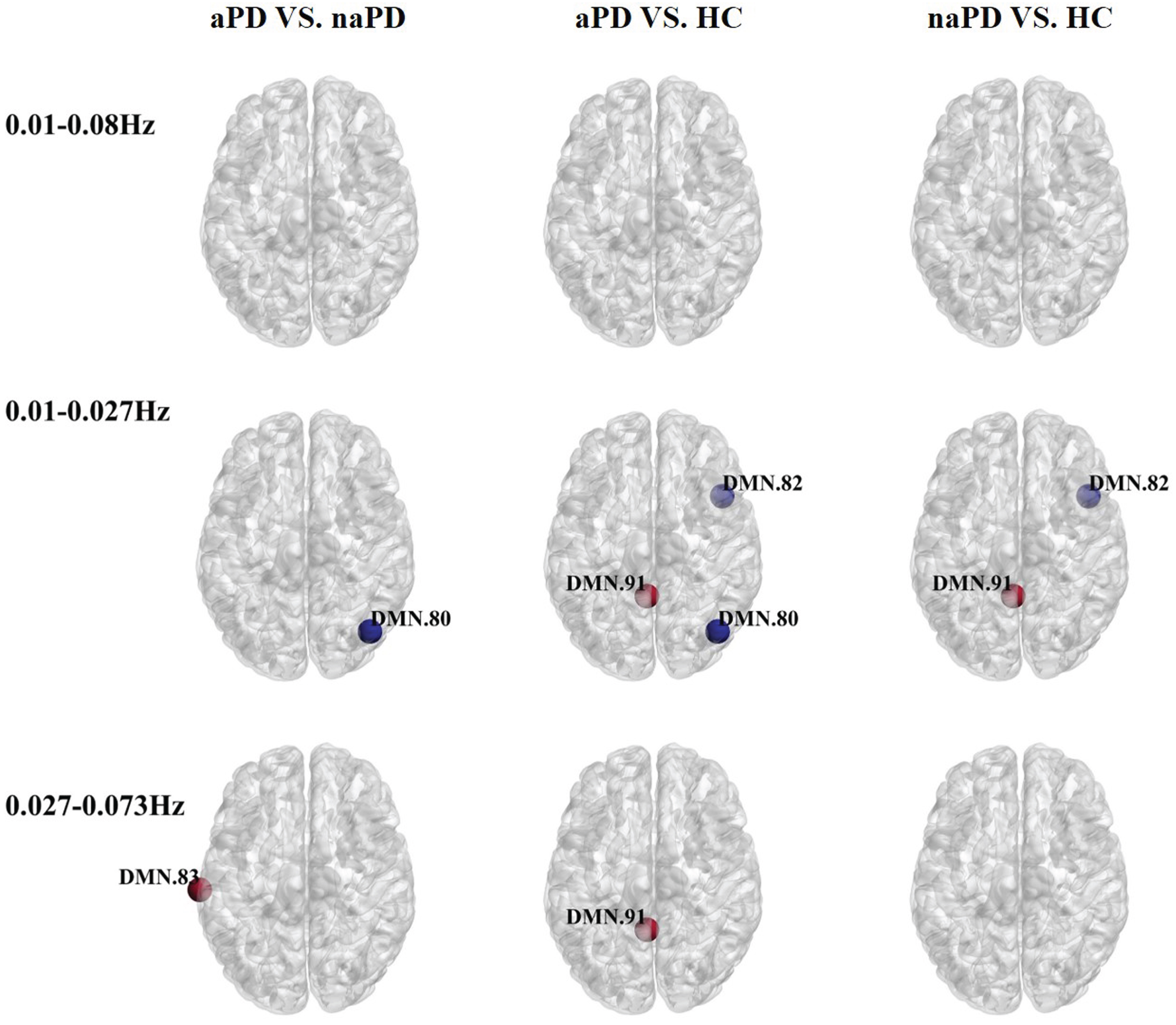 Oscillation-specific alterations of nodal betweenness centrality in PD with or without anxiety. Red nodes suggest an increase in betweenness centrality and blue nodes suggest a decrease in betweenness centrality.