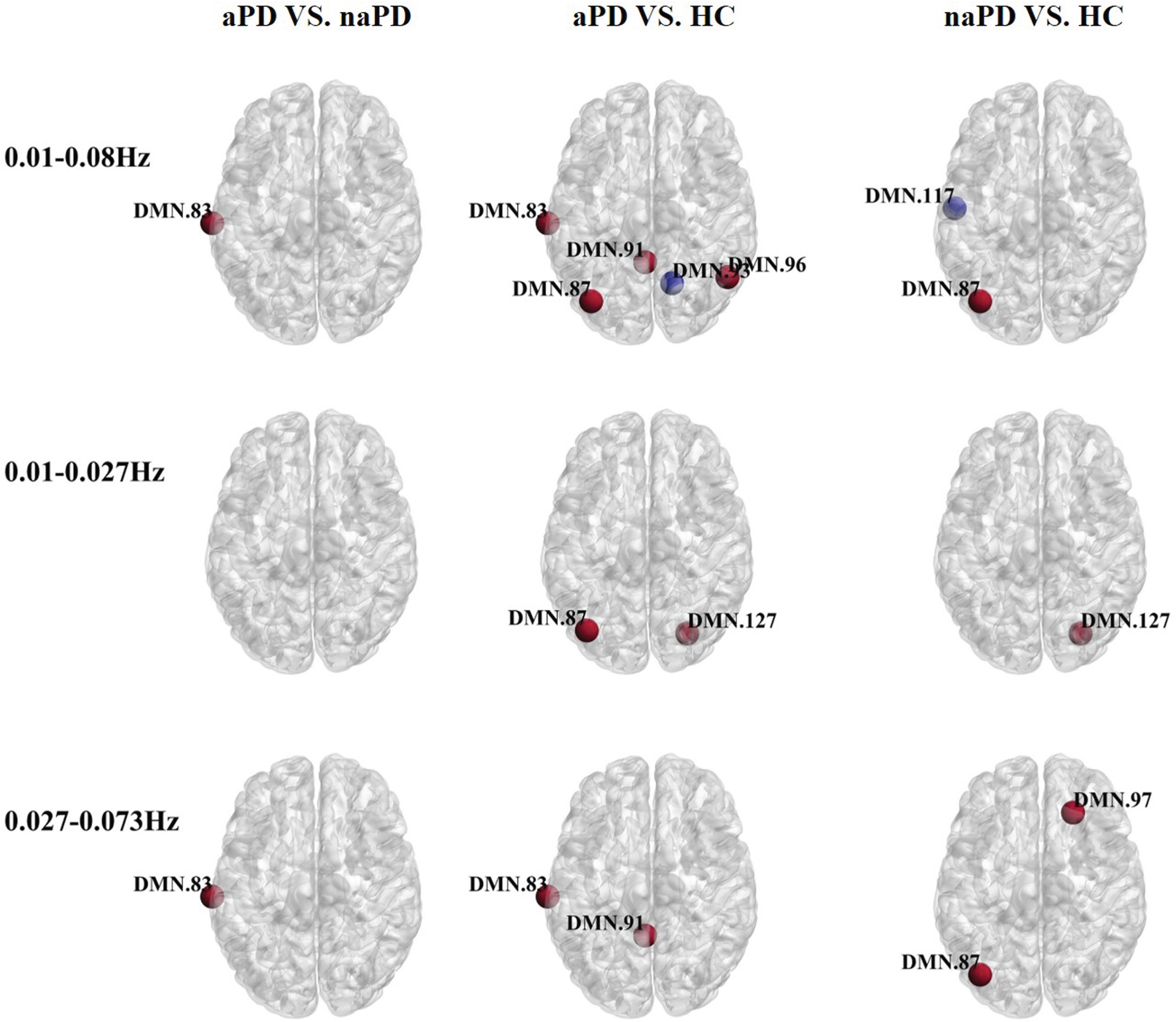 Oscillation-specific alterations of nodal degree centrality in PD with or without anxiety. Red nodes suggest an increase in degree centrality and blue nodes suggest a decrease in degree centrality.