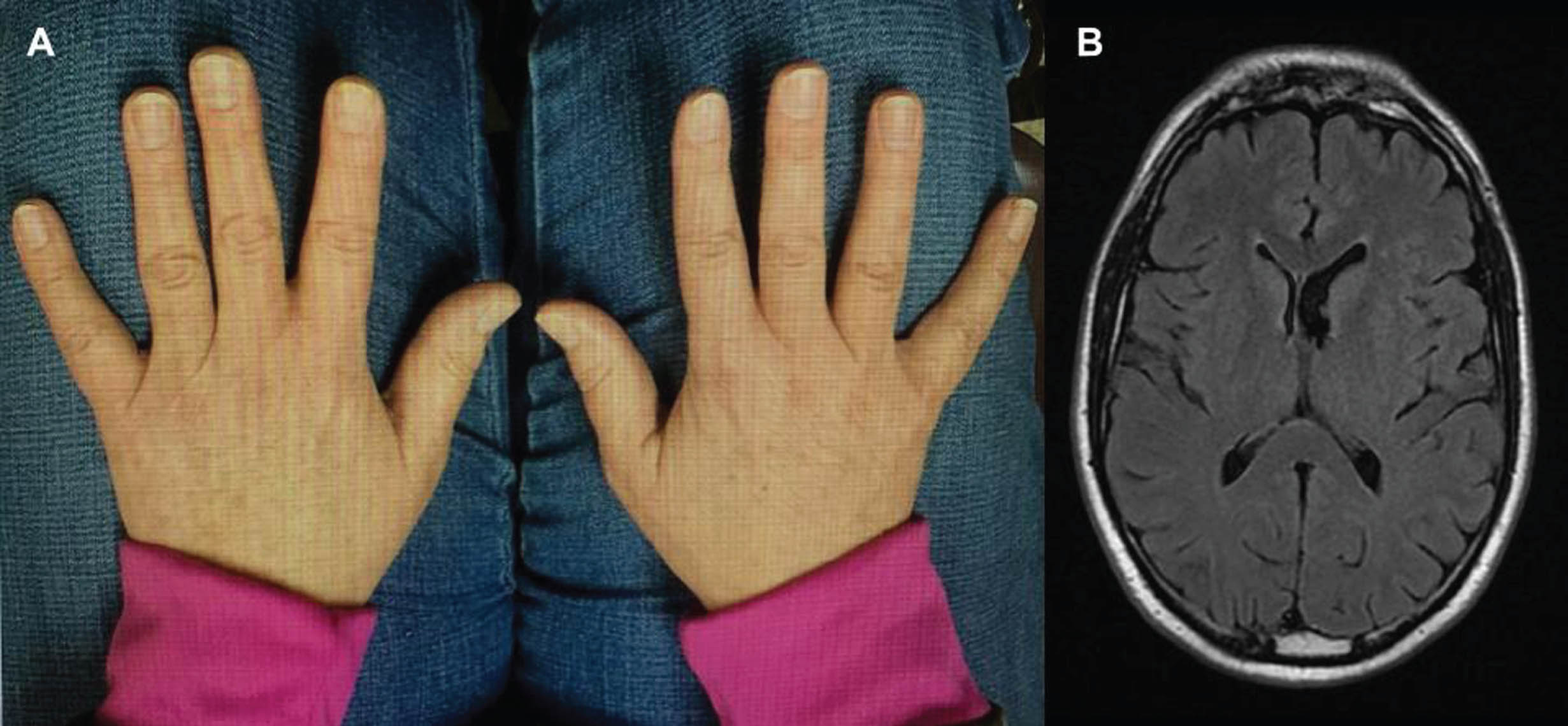 In panel A, the smaller sizes of right-hand digits are evident. The axial FLAIR brain MRI image in panel B shows enlargement of the left lateral ventricle.