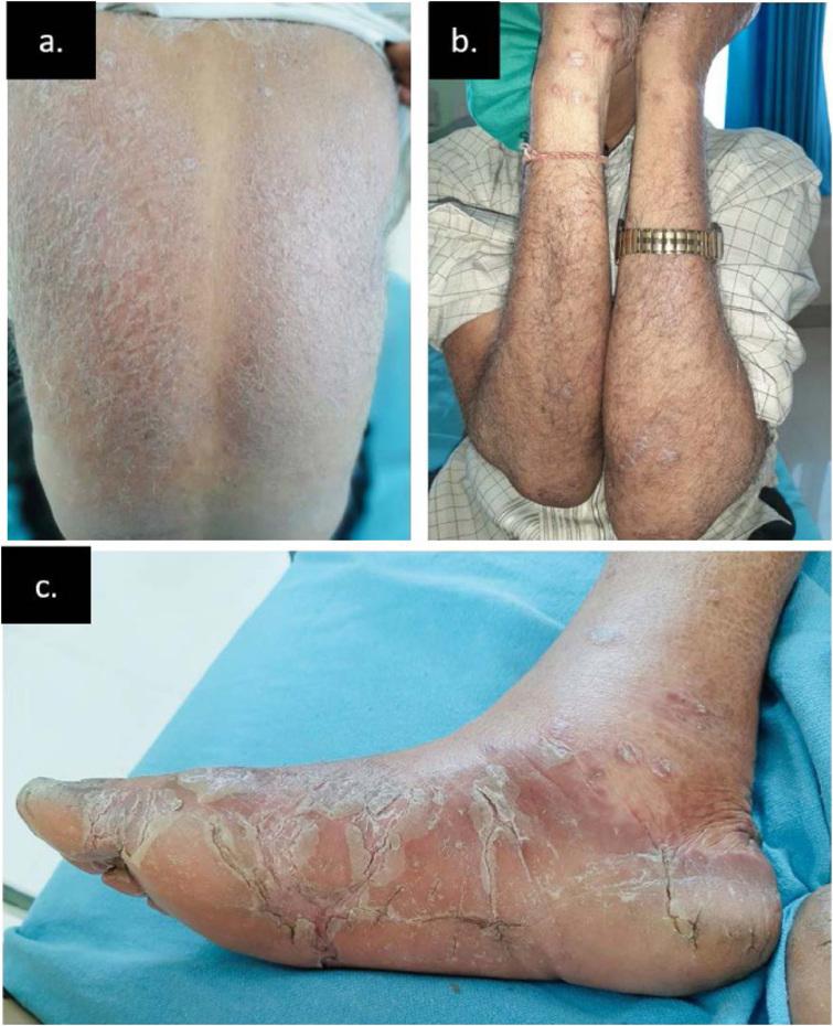 (a) Bilaterally symmetric erythematous scaly follicular papules and plaques present over back with islands of sparing. (b) Bilaterally symmetric ill-defined erythematous scaly follicular papules and plaques over extensors of forearms with lesions involving palms. (c) Scaling and fissuring with plantar keratoderma.