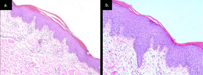 (a) Epidermis shows hyperkeratosis alternating orthokeratosis and parakeratosis with broad rete ridges dermis showing mild perivascular and periadnexal infiltrate (H&E stain, 10X). (b) Epidermis shows hyperkeratosis with alternating parakeratosis and orthokeratosis hypergranulosis (H&E stain, 40X).
