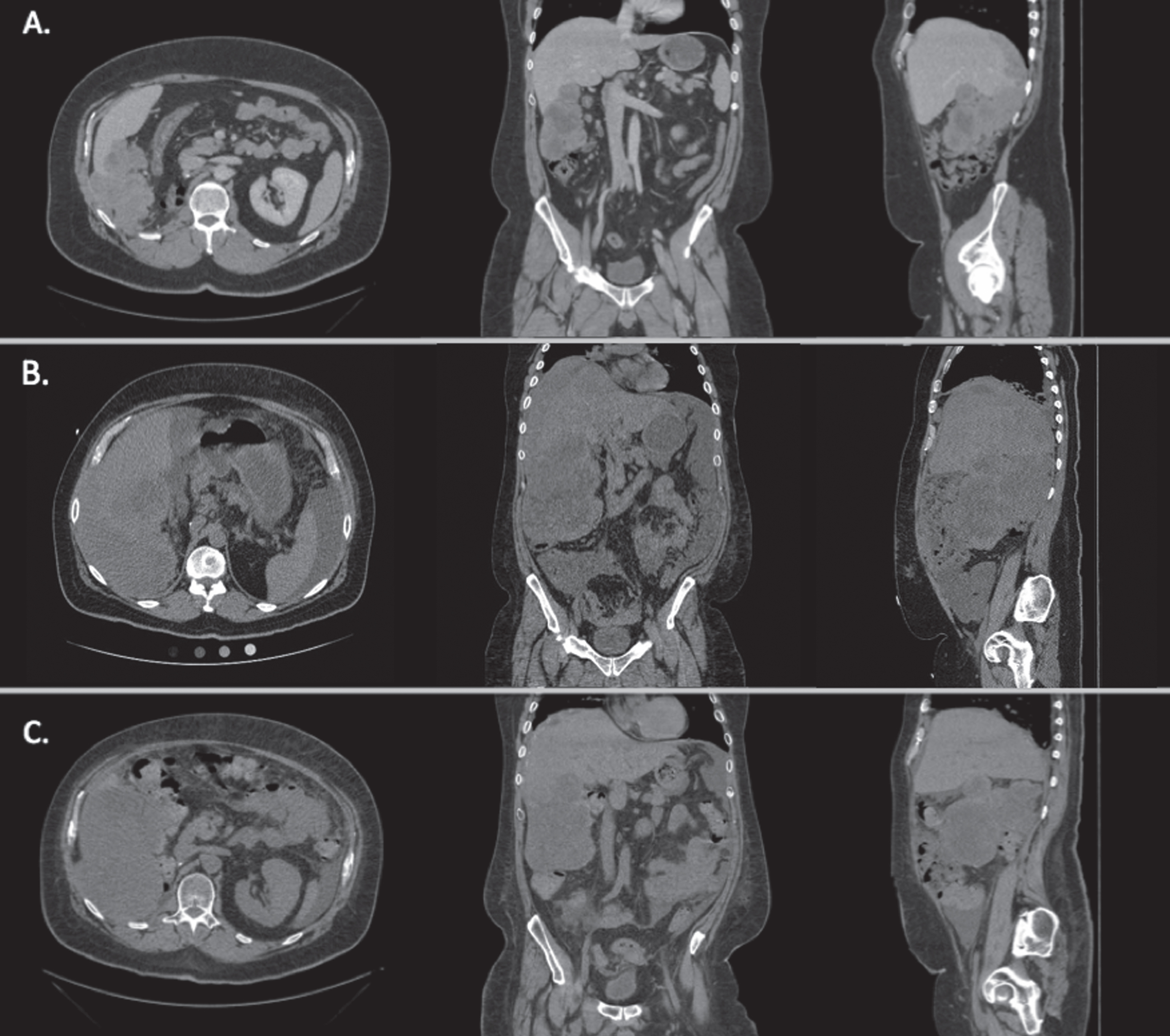 Axial, coronal, and sagittal CT images of the patient’s abdomen and pelvis revealing metastatic disease at different time points during his therapy. A. Prior to sunitinib and gemcitabine therapy. B. After sunitinib and gemcitabine therapy, prior to nivolumab therapy and one month prior to admission. C. 47 days after admission. Image shown after nivolumab and during everolimus therapy. Overall response was mixed as compared to prior to everolimus therapy.