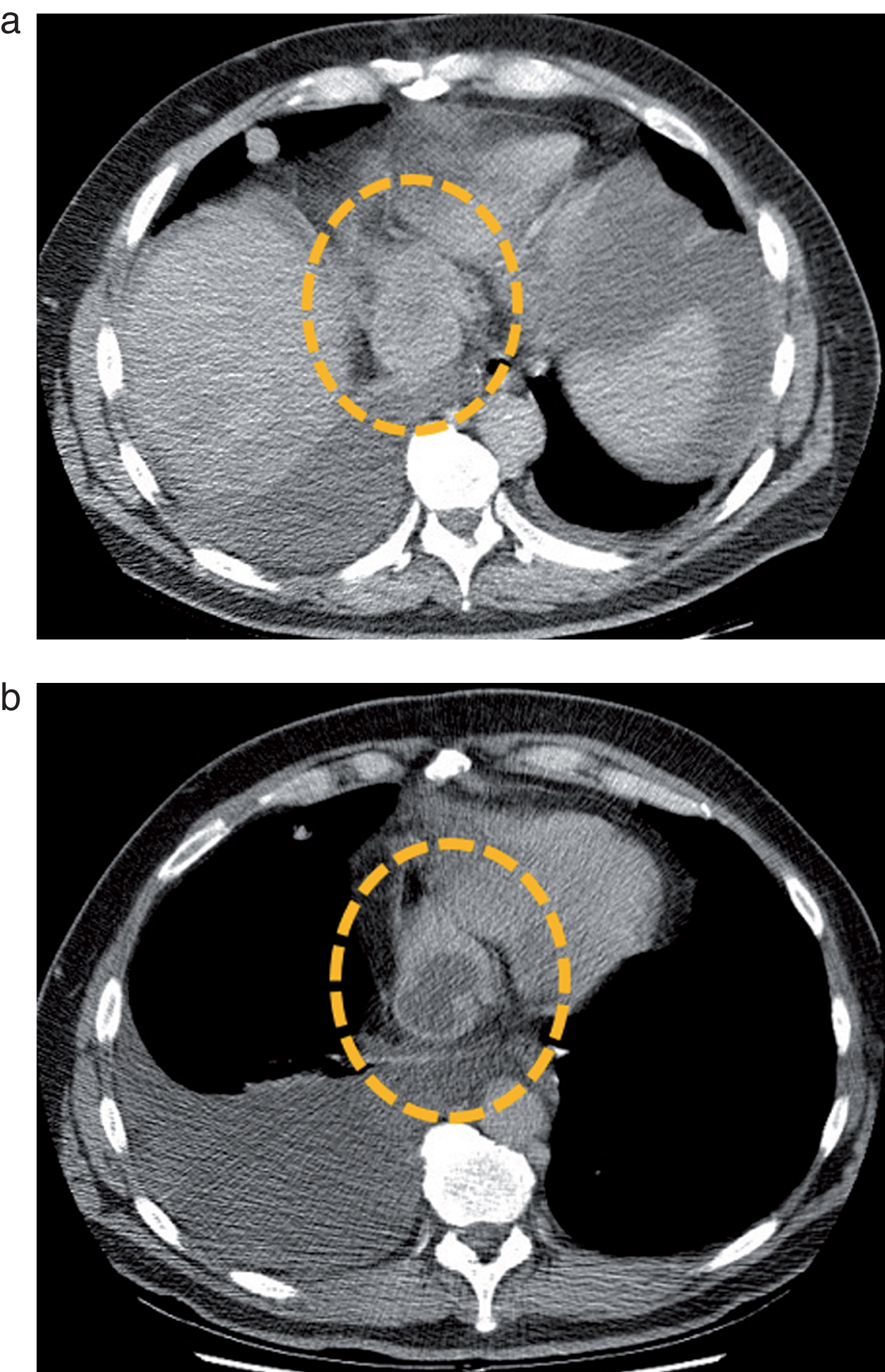 Metastatic mediastinal lymph node of a clear cell RCC before (a) and after (b) a single cycle of treatment by sunitinib. The lymph node (dotted circle) enhances homogeneously before therapy, but presents a central devascularized portion after treatment administration. Based on these observations, several teams tested Choi criteria in mRCC.