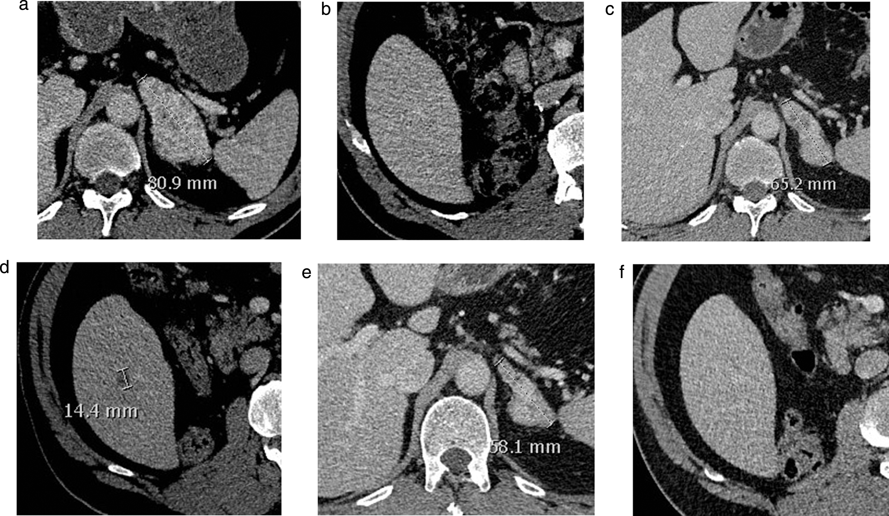 Baseline (a, b) and follow-up CT-scan at 6 months (c, d) and 8 months (e, f) showing an adrenal metastasis (respectively a, c, e) and the liver (respectively b, d, f) in a mRCC patient under nivolumab. No liver lesion was observed on the initial workup (b). A liver lesion appeared after 6 months (d) despite decrease in other lesions (c). On the following workup, the lesion had disappeared, while observing further response of the other lesions. This represents an example of pseudo-progression. The patient went on to respond for 7 months under therapy.