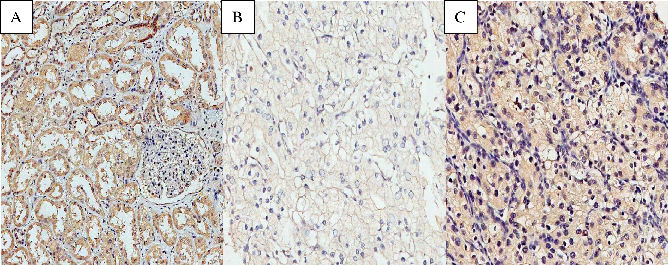 Photomicrographs of immunohistochemical expression of EPO. (A) Positive expression of EPO in non-neoplastic renal cortex. (B) Negative expression of EPO in ccRCC. (C) Positive expression of EPO in ccRCC. Original magnification: 400 X.