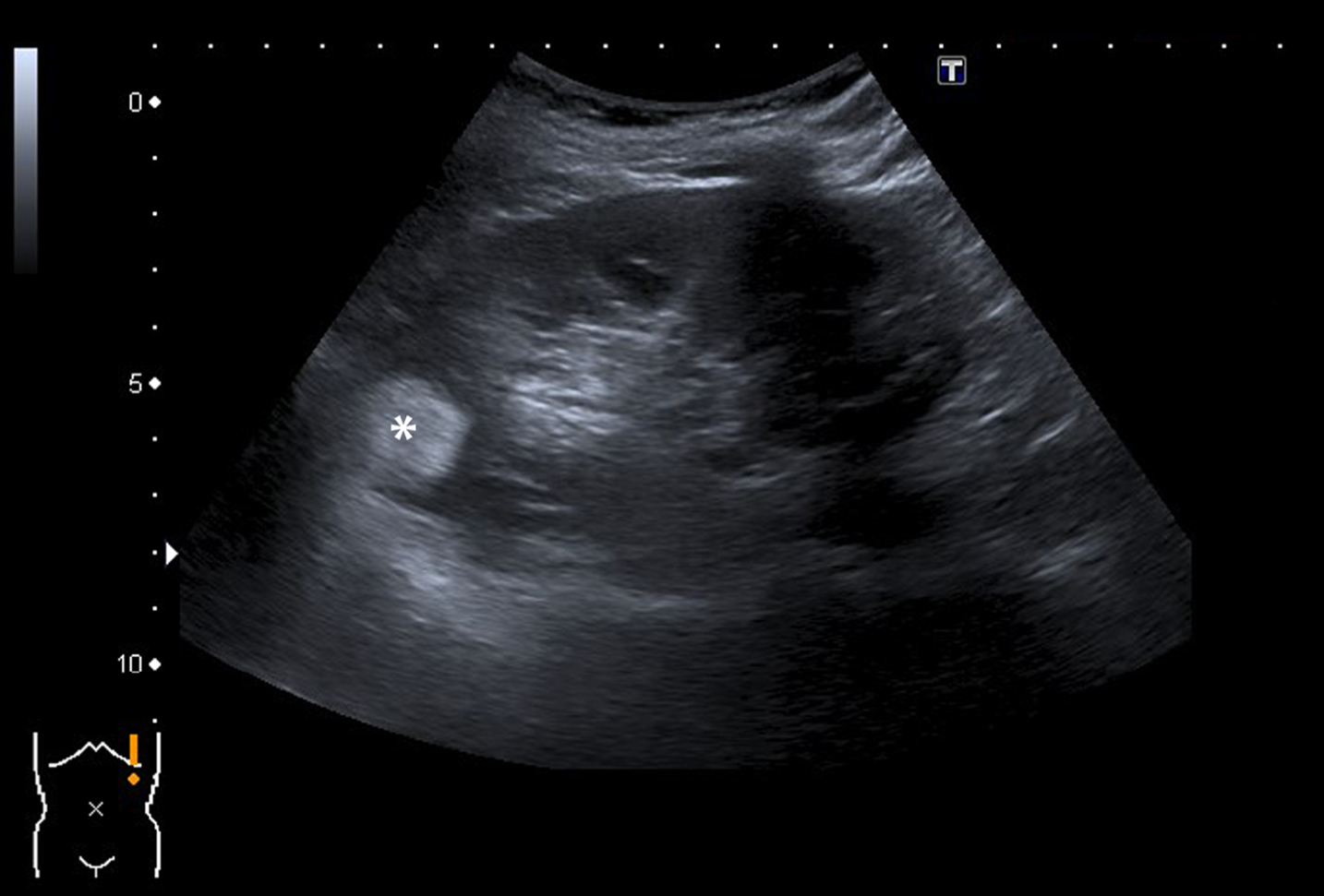 A 63-year-old women was referred for follow up of an angiomyolipoma previously diagnosed on CT scan. Ultrasound during follow up indeed showed a 25 mm large, strong hyperechoic tumor (marked with an asterix) in the upperpole of the left kidney consistent with an angiomyolipoma. The echogenicity corresponds with a composition of fat, also when compared to fat in the renal hilum.