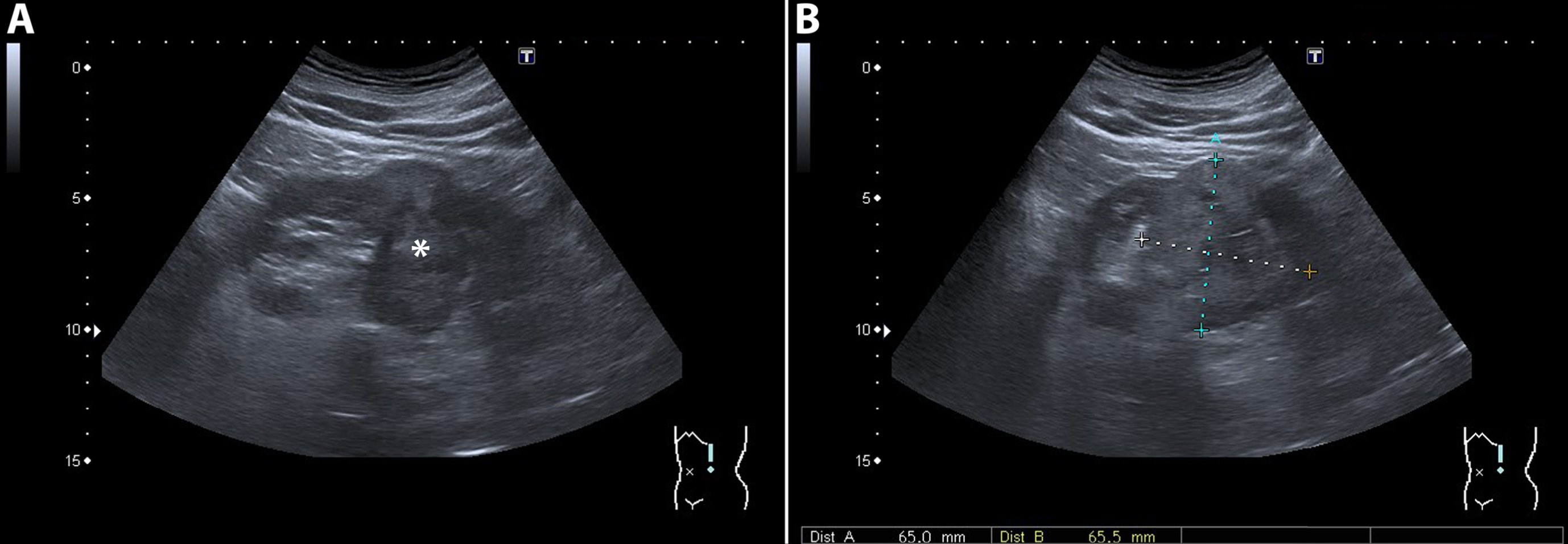 A 78-year-old man underwent ultrasound of the kidneys because of progressive renal function impairment. On the ultrasound a 65 mm large tumor (marked with an asterix) was detected in the middle/lower pole of the left kidney. The tumor was heterogeneous on ultrasound with mixed isoechoic and hyperechoic areas. A subsequent CT confirmed the presence of a renal tumor with a heterogeneous aspect and strong contrast enhancement suspect for RCC. Pathology report showed a 120 mm large Fuhrman grade II clear cell RCC.