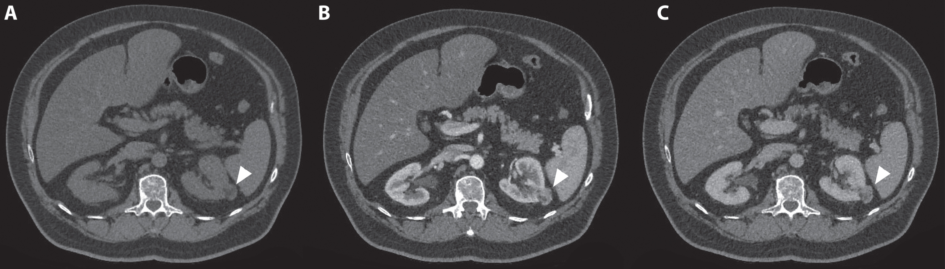 A 72-year-old man was referred for an incidentaloma found on a CT scan of the thorax, which included a part of the kidneys. A 3-phase CT scan showed a 28-mm×24-mm large interpolar tumor of the left kidney (marked with white arrowhead). On unenhanced CT, the lesion had areas of fat with an attenuation of –36 Hounsfield units (HU). (A) In the corticomedullary phase, avid tumor enhancement is seen (B) with a moderate washout effect in the nephrogenic phase (C). These CT findings are consistent with an angiomyolipoma. However, fat-containing renal cell carcinoma (RCC) cannot be entirely excluded as a diagnosis, and this lesion will be monitored with imaging.