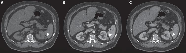 A 72-year-old man was referred for an incidentaloma found on a CT scan of the thorax, which included a part of the kidneys. A 3-phase CT scan showed a 28-mm×24-mm large interpolar tumor of the left kidney (marked with white arrowhead). On unenhanced CT, the lesion had areas of fat with an attenuation of –36 Hounsfield units (HU). (A) In the corticomedullary phase, avid tumor enhancement is seen (B) with a moderate washout effect in the nephrogenic phase (C). These CT findings are consistent with an angiomyolipoma. However, fat-containing renal cell carcinoma (RCC) cannot be entirely excluded as a diagnosis, and this lesion will be monitored with imaging.