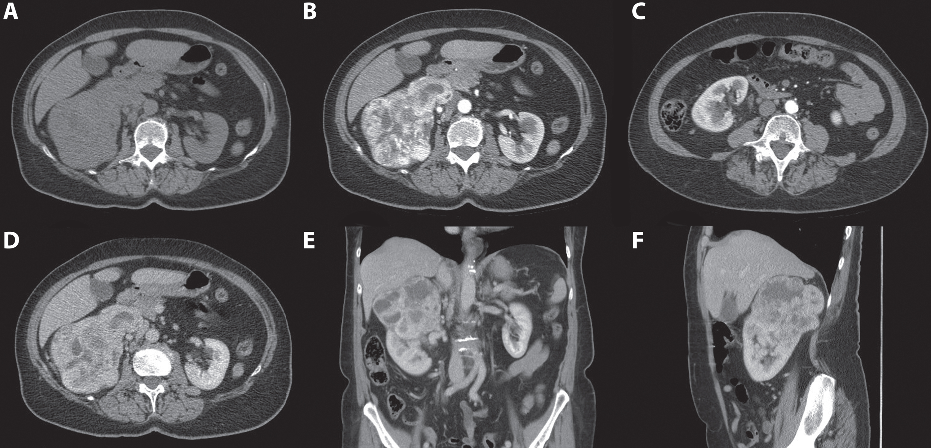 A 70-year-old women was evaluated for flank pain and hematuria. A screening ultrasound showed a hypervascular and hyperechoic renal mass of the right kidney. A 3-phase CT scan showed a tumor originating from the upper pole of the right kidney which measured approximately 124 mm×77 mm×95 mm. During the non-contrast phase the tumor showed a heterogeneous aspect with mixed attenuation consistent with parts of central tumor necrosis. (A) Strong enhancement of the solid parts is seen in the corticomedullary phase. (B) The lower pole of the right kidney was unaffected. (C) In the nephrogenic phase, a clear washout effect is seen. (D) Coronal (E) and saggital (F) reconstructions in the nephrogenic phase confirm the tumor to be located mainly in the upper pole with growth toward the liver and centrally towards the renal hilum. Histopathology after open radical nephrectomy confirmed the diagnosis of a 120 mm large, Furhman grade 3, clear cell renal cell carcinoma.