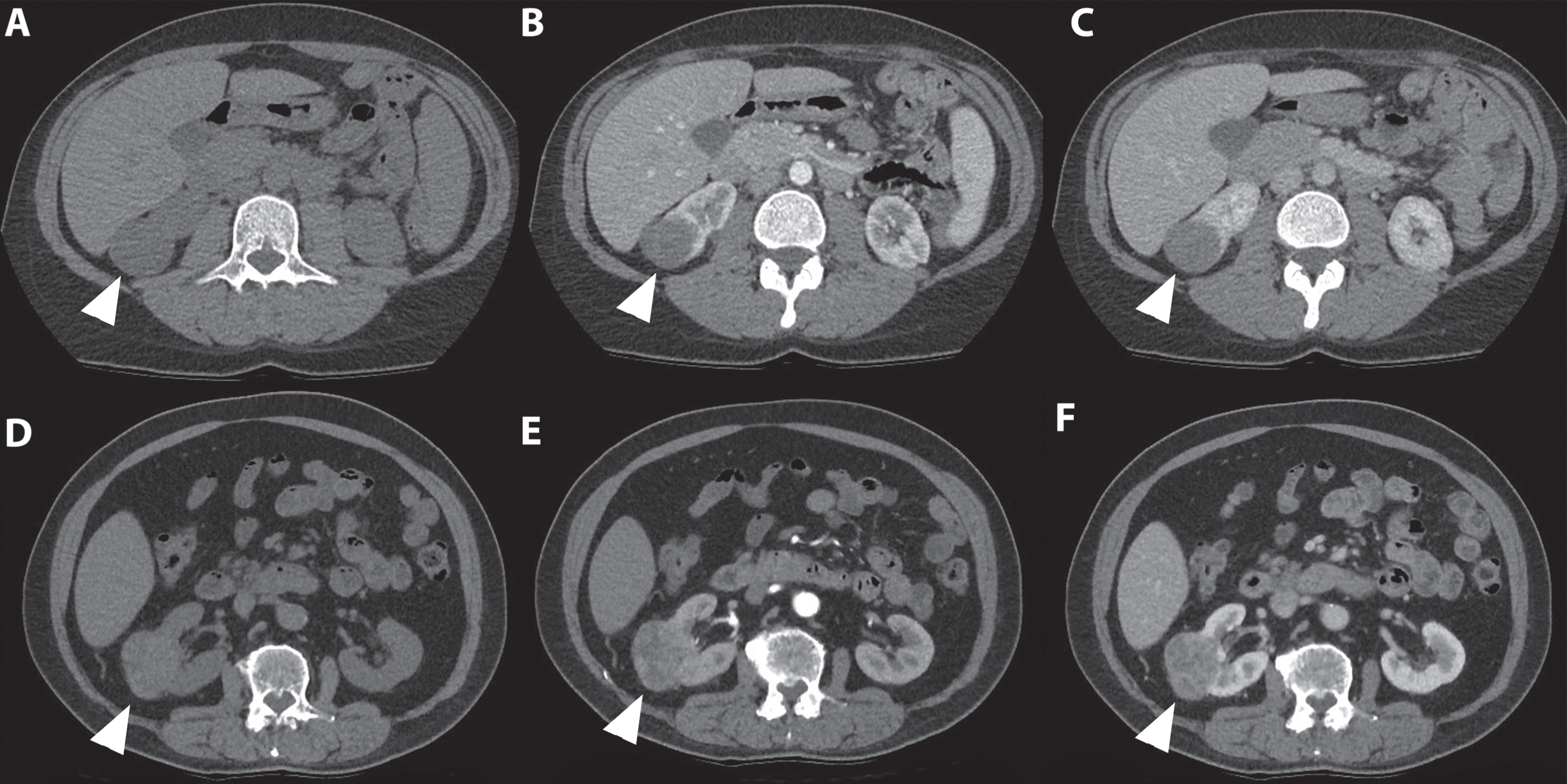 In this figure the difference in appearance and enhancing pattern of clear cell and papillary renal cell carcinoma are shown. The first case (A-C) concerns a 41-year-old women referred for analysis of an incidentaloma of the right kidney detected on ultrasound. A 3-phase CT scan showed a 36-mm large tumor of the lower pole of the right kidney with a typical gradual enhancement pattern with, as opposed to the clear cell RCC case, no washout in the nephrogenic phase. On unenhanced CT, the tumor appears homogeneous and the Hounsfield unit value of the tumor was 31. (A) The corticomedullary (B) and nephrogenic phase (C) showed homogeneous enhancement of the tumor with Hounsfield unit values of 31 and 68, respectively. Histopathology after robot-assisted partial nephrectomy confirmed the diagnosis of a 38-mm large, Furhman grade 4 papillary renal cell carcinoma. The second case (D-F) concerns a 67-year-old man in whom an incidentaloma in the right kidney was found on MRI of the spinal canal. The tumor was evaluated through a CT scan which showed a 67 mm large, interpolar tumor of the right kidney. The non-contrast phase showed a heterogeneous aspect with mixed attenuation (A), in the corticomedullary phase strong enhancement of the solid parts is seen (B) with subsequent washout in the nephrogenic phase (C). The latter is best seen when comparing the enhancement with the renal cortex.