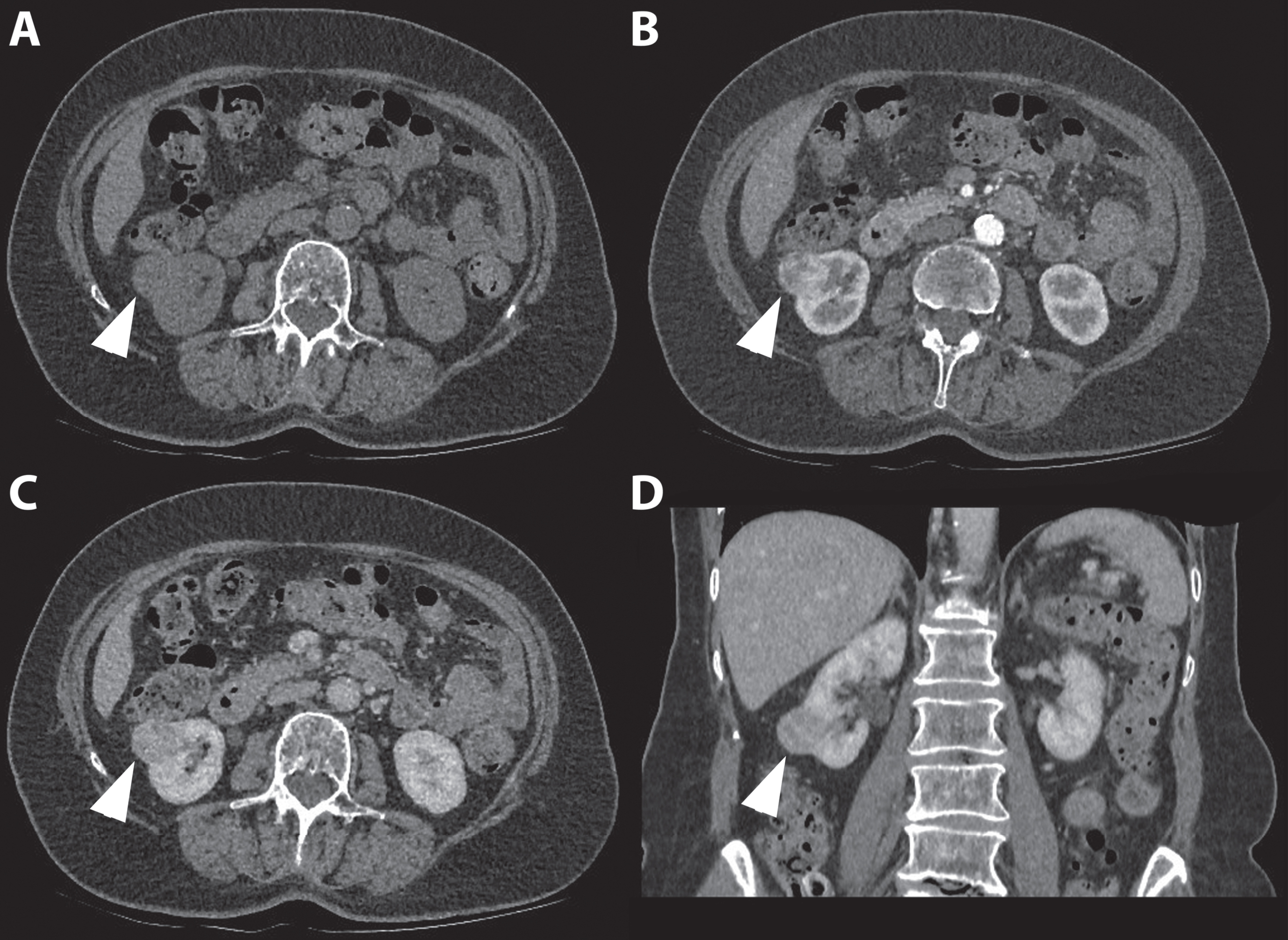 An 80-year-old women was referred for an incidentaloma of the right kidney detected on ultrasound. A 3 phase CT scan showed an isoattenuating, exophytic growing renal tumor of the right lower pole on the non-contrast phase. (A) An inhomogeneous avid enhancement pattern is seen in the corticomedullary phase (B) followed by wash out during the nephrogenic phase (C and D). The patient was treated with percutaneous image-guided cryoablation. Intraoperative biopsy specimens showed an oncocytoma.